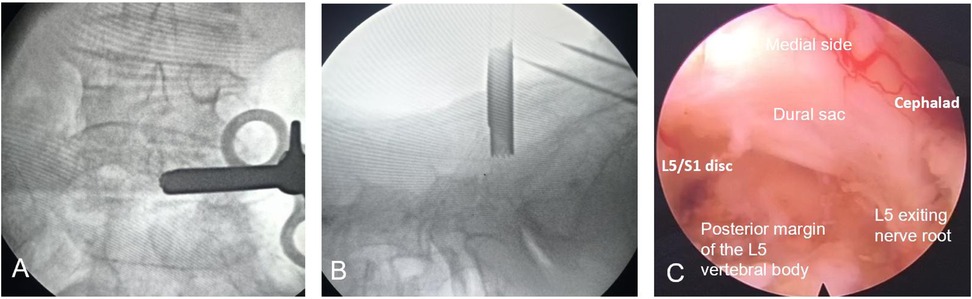 Three-panel image showing stages of a spinal procedure. Panel A is a fluoroscopic view of the lumbar spine with a surgical instrument introduced near the vertebrae. Panel B shows a lateral fluoroscopic view with a needle or cannula inserted toward the spine. Panel C is an intraoperative endoscopic image identifying key anatomical structures at the L5/S1 level, including the dural sac, L5 exiting nerve root, L5/S1 disc, and posterior margin of the L5 vertebral body.