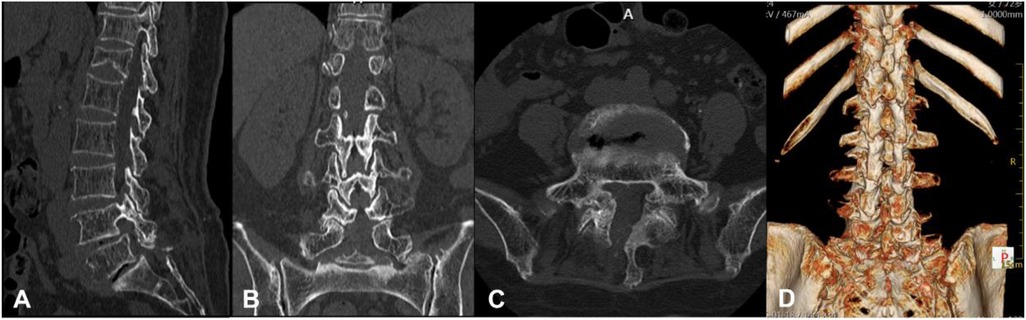 Four-panel CT imaging of the lumbar spine. Panel A shows a sagittal view with clear visualization of vertebral alignment and disc spaces. Panel B displays a coronal view demonstrating vertebral symmetry and joint articulation. Panel C presents an axial view of a lumbar vertebra with visible spinal canal and bony structures. Panel D features a 3D reconstructed posterior view of the thoracolumbar spine, showing ribs, vertebrae, and anatomical orientation.