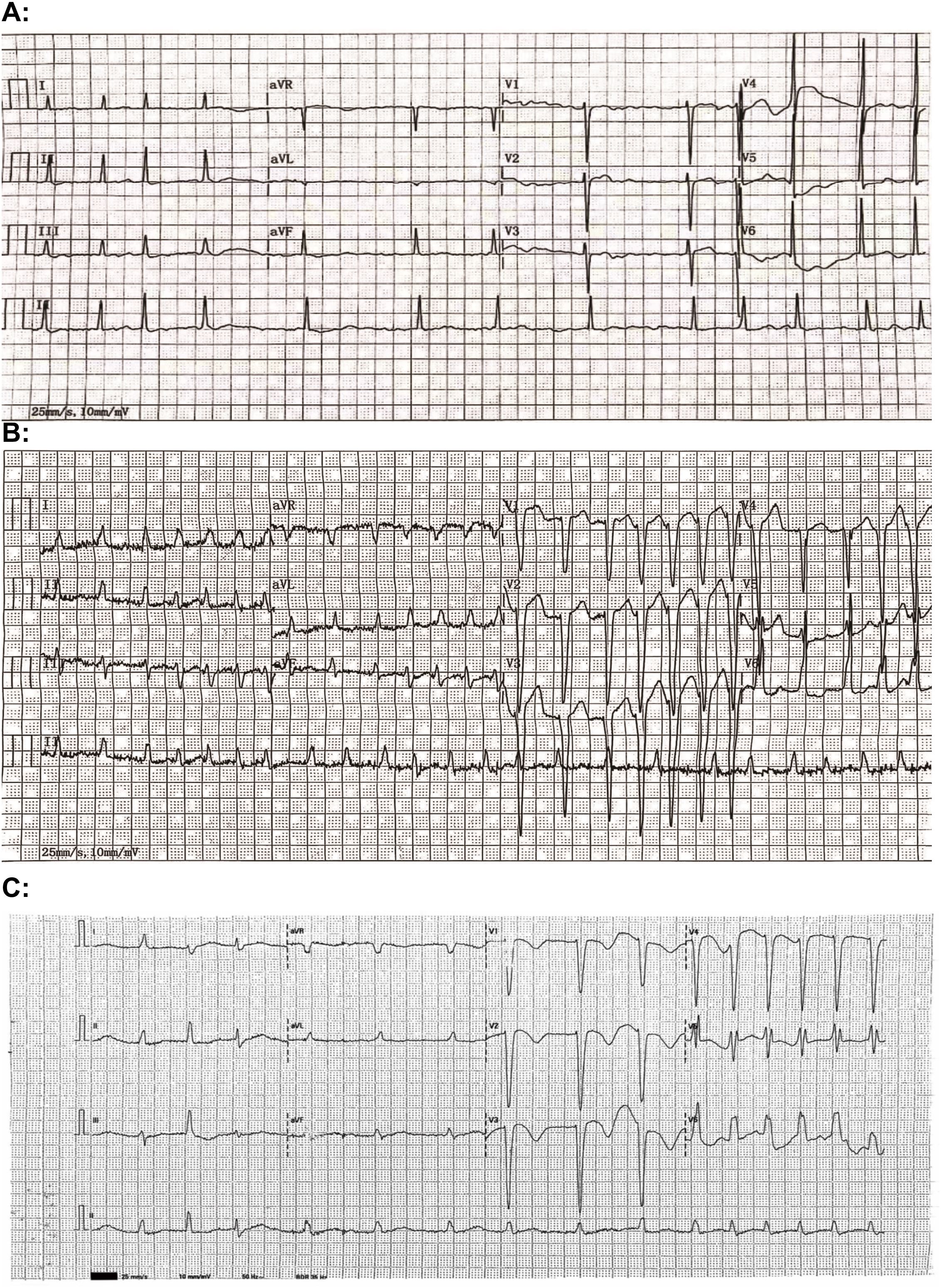 Electrocardiogram strips labeled A, B, and C. Strip A shows a regular sinus rhythm. Strip B shows a pattern consistent with ventricular tachycardia, demonstrating wide QRS complexes. Strip C shows a return to a regular sinus rhythm with normal QRS complexes.