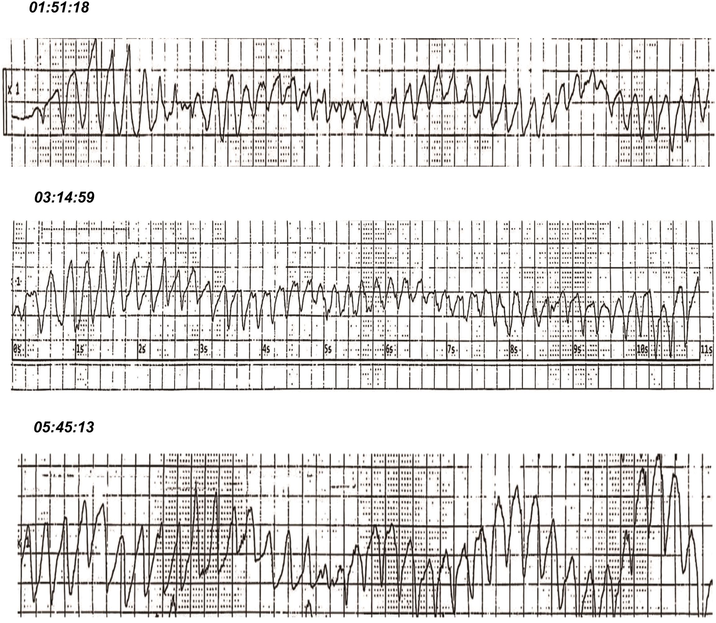 Three electrocardiogram (ECG) readings are shown with timestamps. The patterns display variations in heart activity over time. Each waveform varies in amplitude and frequency, representing different heartbeats at different times: 01:51:18, 03:14:59, and 05:45:13.