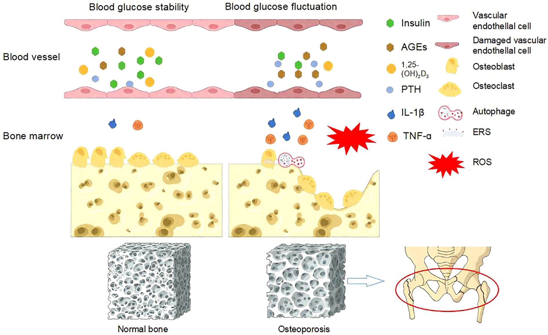 Diagram showing the effects of blood glucose stability and fluctuation on blood vessels and bone marrow. Stable glucose levels maintain normal bone structure, while fluctuations lead to damaged cells, oxidative stress (ROS), and osteoporosis. The diagram includes labels for insulin, AGEs, vitamin D3, PTH, interleukin-1 beta, TNF alpha, and various cell types. A comparison between normal bone and osteoporotic bone structure is provided, highlighting deterioration.