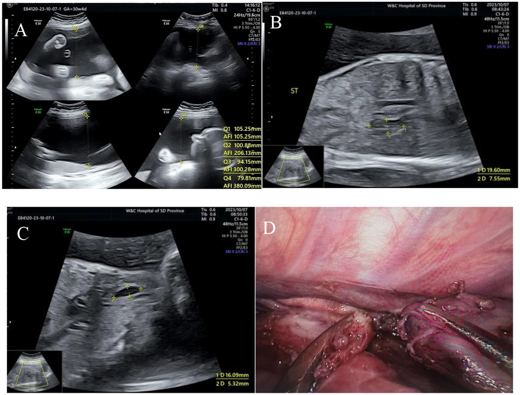 Ultrasound images labeled A, B, and C showcase cross-sectional views of anatomical structures with measurement markers indicating dimensions and depths. Image D is an intraoperative photograph displaying detailed anatomical structures seen during surgery.