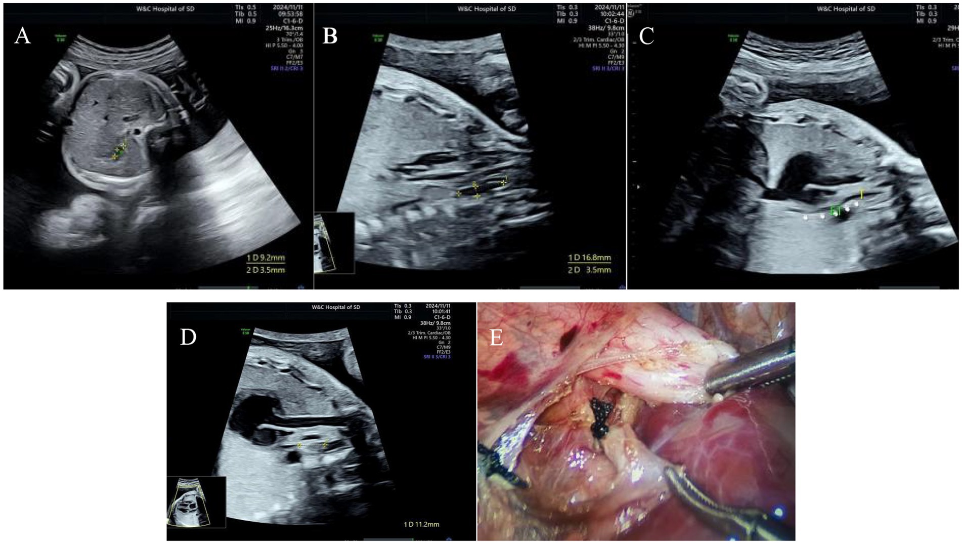 Ultrasound images labeled A, C, and D show different angles of an abdomen with measurements. Image E displays a surgical procedure with visible tissue and surgical tools.