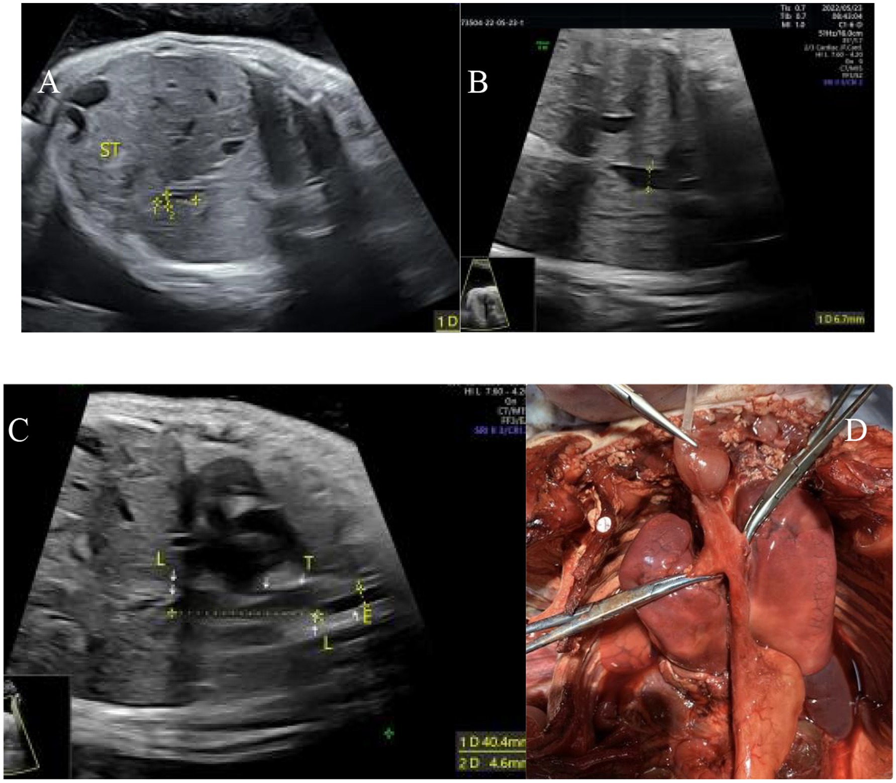 Ultrasound images labeled A, B, and C show different views of an abdominal area with measurements and labels such as