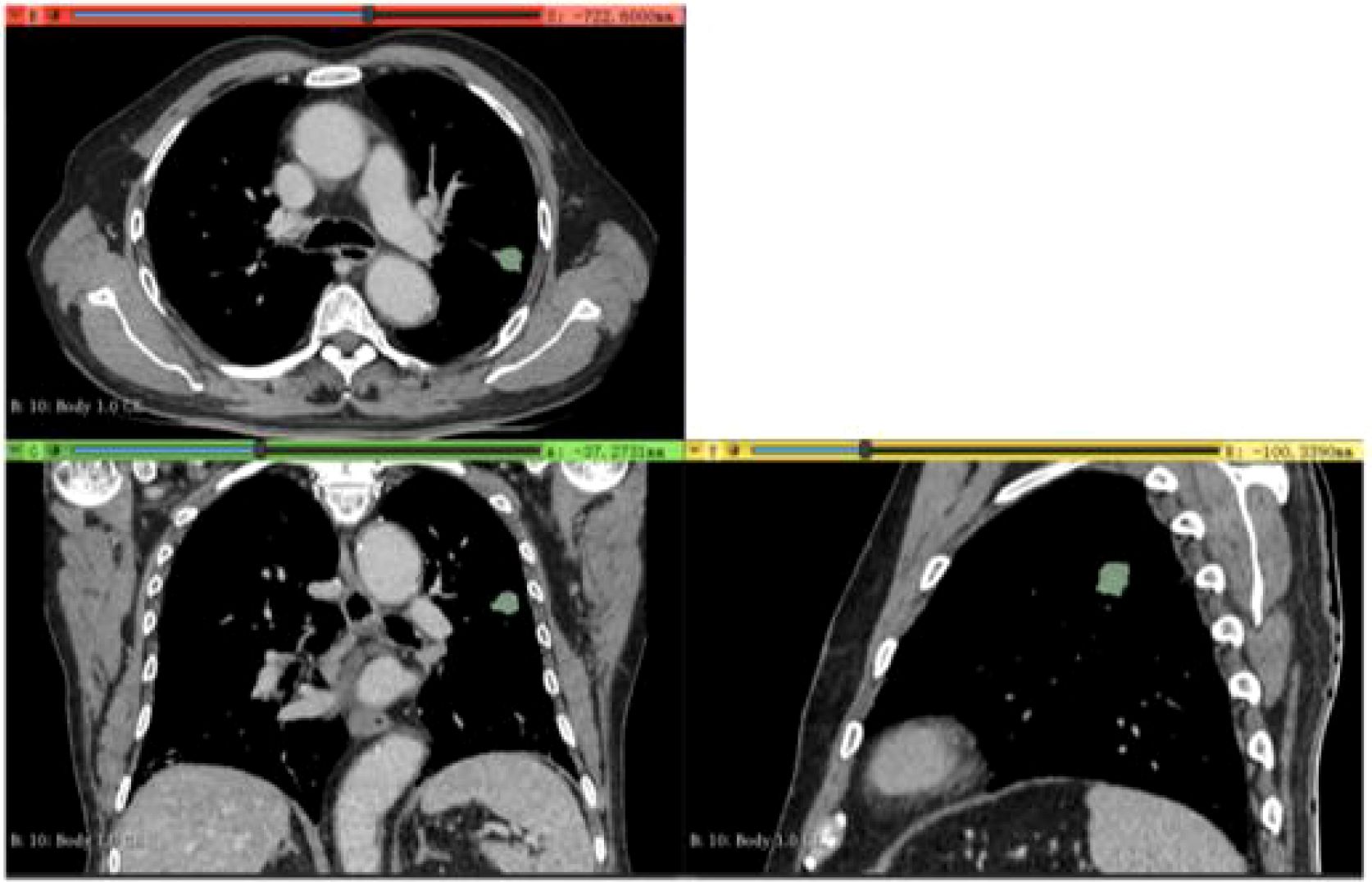 CT scan images in a three-panel view showing different cross-sections of the chest area. The top left panel displays a cross-sectional view, while the bottom left shows a frontal orientation. The right panel offers a side view. A highlighted area in green is visible in all panels, possibly indicating a region of interest or abnormality.