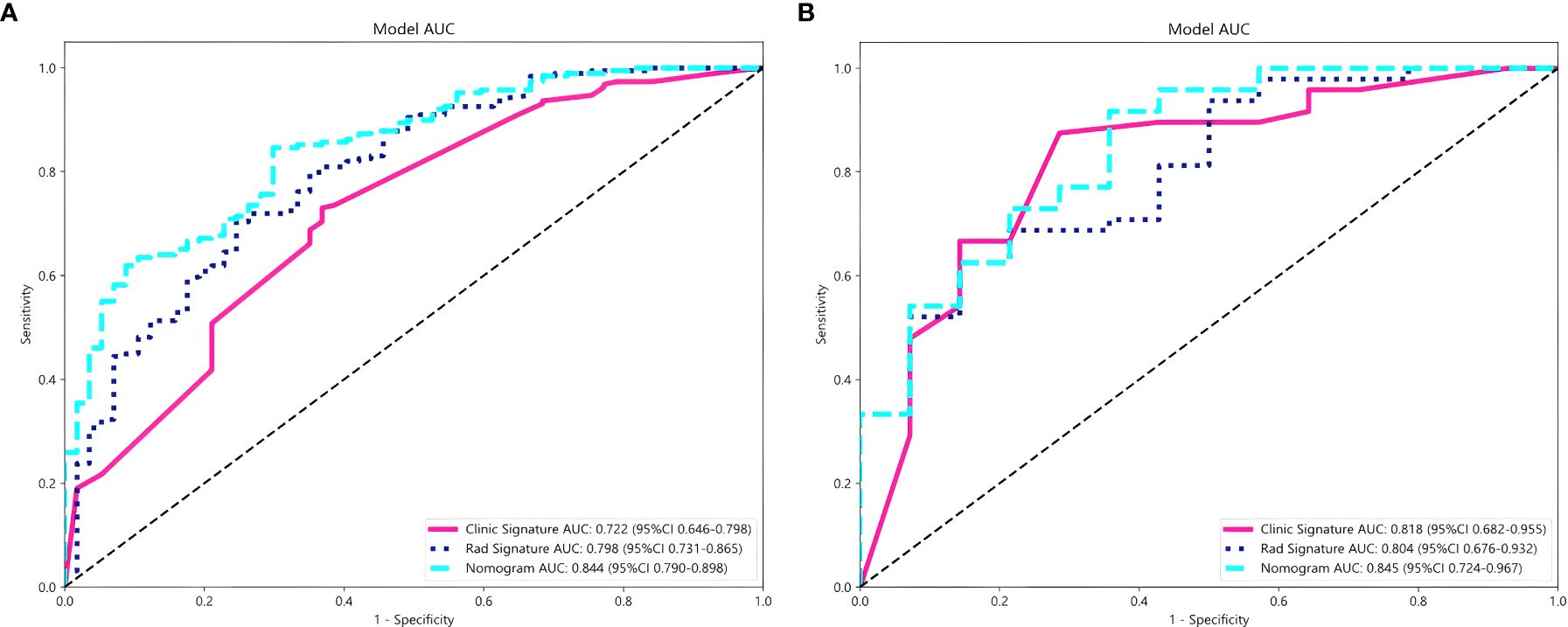 Two ROC curves labeled A and B, comparing diagnostic tests. Both charts plot sensitivity against 1-specificity. Curve A includes a pink line for Clinic Signature with AUC 0.722, blue dashed line for Rad Signature with AUC 0.798, and cyan dashed line for Nomogram with AUC 0.844. Curve B shows Clinic Signature's AUC as 0.818, Rad Signature's AUC as 0.804, and Nomogram's AUC as 0.845. Dotted diagonal lines represent random chance.