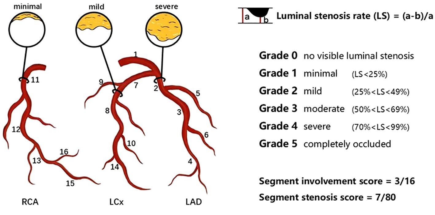 Diagram of coronary artery stenosis showing minimal, mild, and severe cases with cross-sectional illustrations. The left panel depicts coronary arteries labeled RCA, LCx, and LAD with numbered segments. On the right, a scale defines stenosis grades: 0 (no stenosis), 1 (minimal), 2 (mild), 3 (moderate), 4 (severe), 5 (occluded). Formulas and scores are given: Luminal stenosis rate, segment involvement score = 3/16, and segment stenosis score = 7/80.