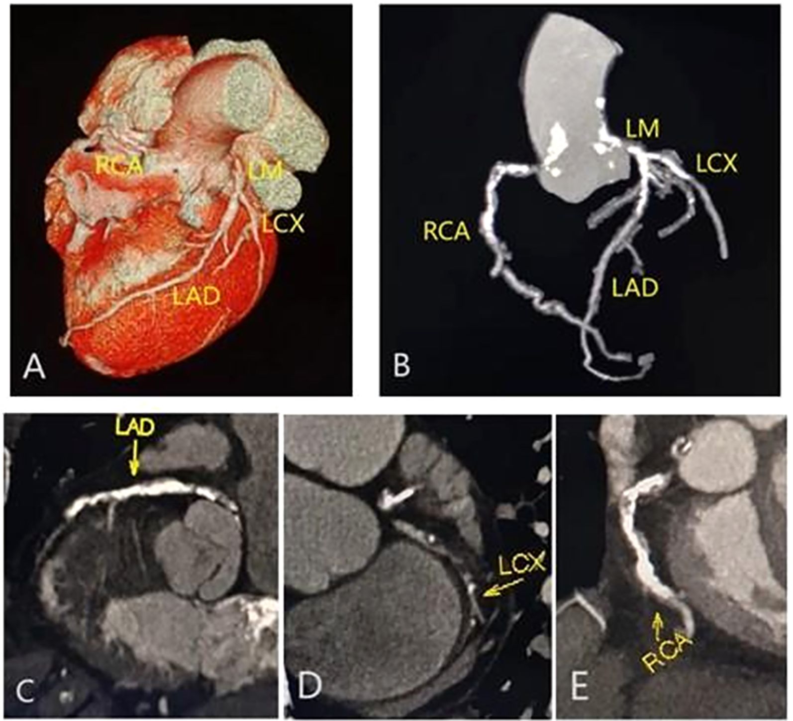 The image consists of five medical illustrations labeled A to E, showing different views of coronary arteries. Panel A displays a 3D model of a heart highlighting the RCA, LM, LCX, and LAD arteries. Panel B shows a schematic diagram of the same arteries. Panels C to E are detailed cross-sectional scans focusing on individual coronary arteries: C on LAD, D on LCX, and E on RCA, each labeled accordingly.