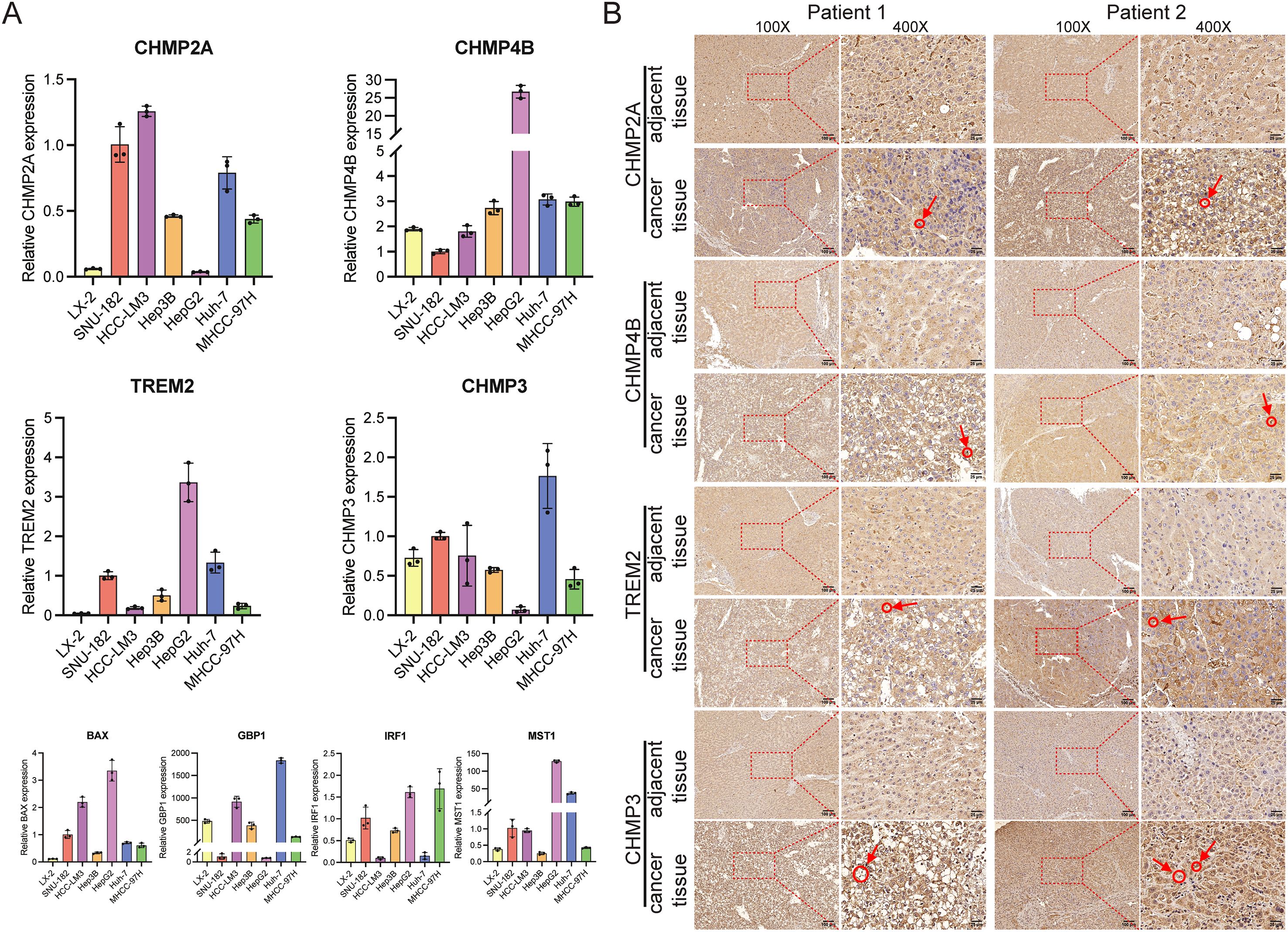 Panel A displays bar graphs illustrating the relative expression levels of CHMP2A, CHMP4B, TREM2, and CHMP3 across eight different cell lines, showing varying expression patterns with error bars. Panel B presents microscopic images of cancer and adjacent tissues from two patients, highlighting CHMP2A, CHMP4B, TREM2, and CHMP3 at 100X and 400X magnifications. Red arrows indicate particular features in the tissues.