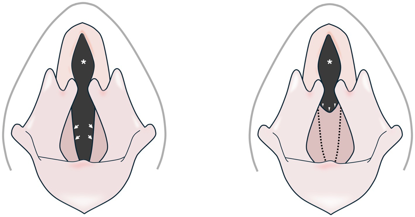 Two diagrams depict a laryngeal view of vocal folds. The left image shows vocal folds in a partially closed position with arrows indicating movement. The right image illustrates vocal folds in a closed position, marked with lines to indicate closure.