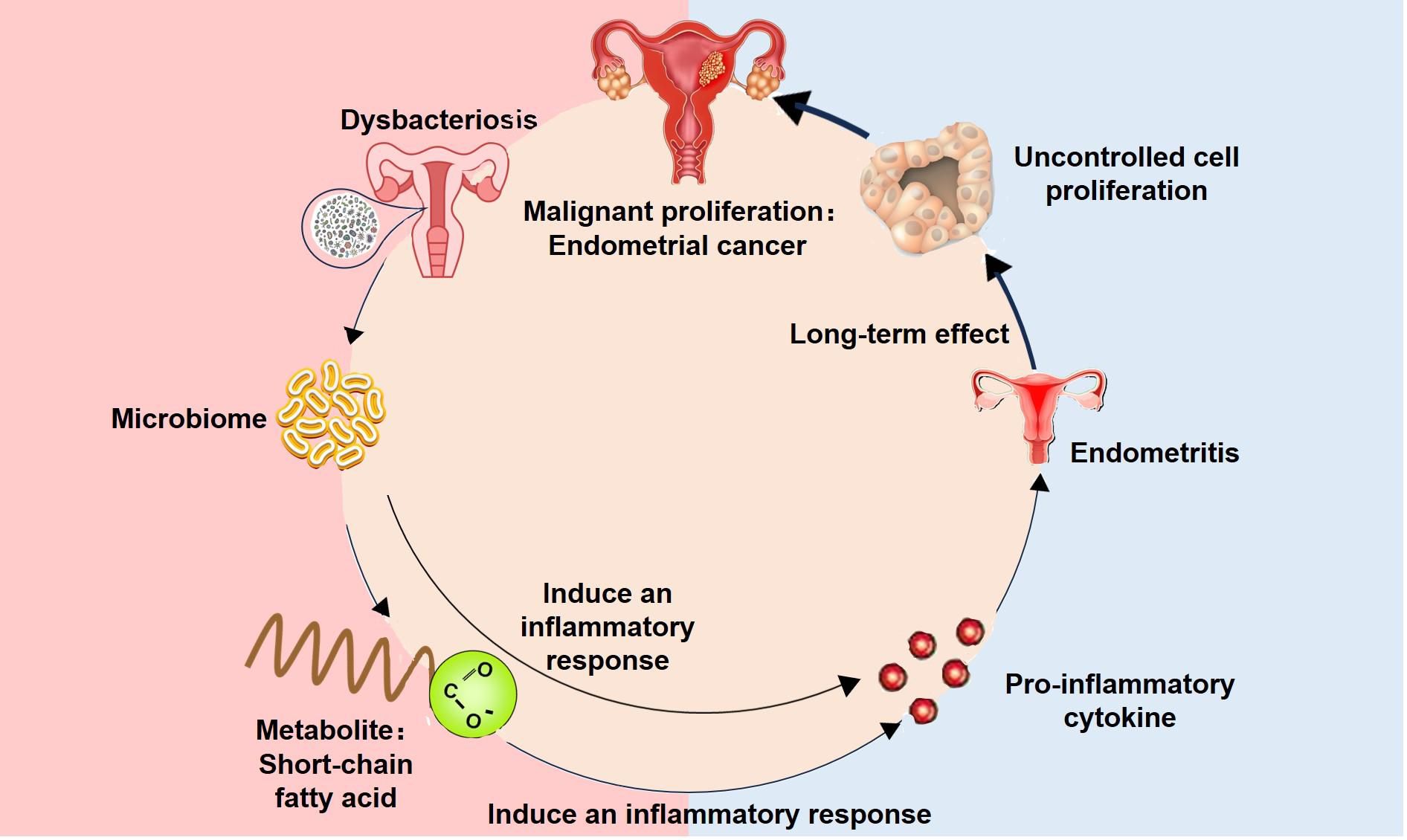 Cycle diagram illustrating the link between dysbacteriosis, microbiome changes, and endometrial cancer. It shows dysbacteriosis leading to microbiome alterations and increased metabolites prompting inflammation, which can lead to pro-inflammatory cytokines, endometritis, uncontrolled cell proliferation, and ultimately endometrial cancer.