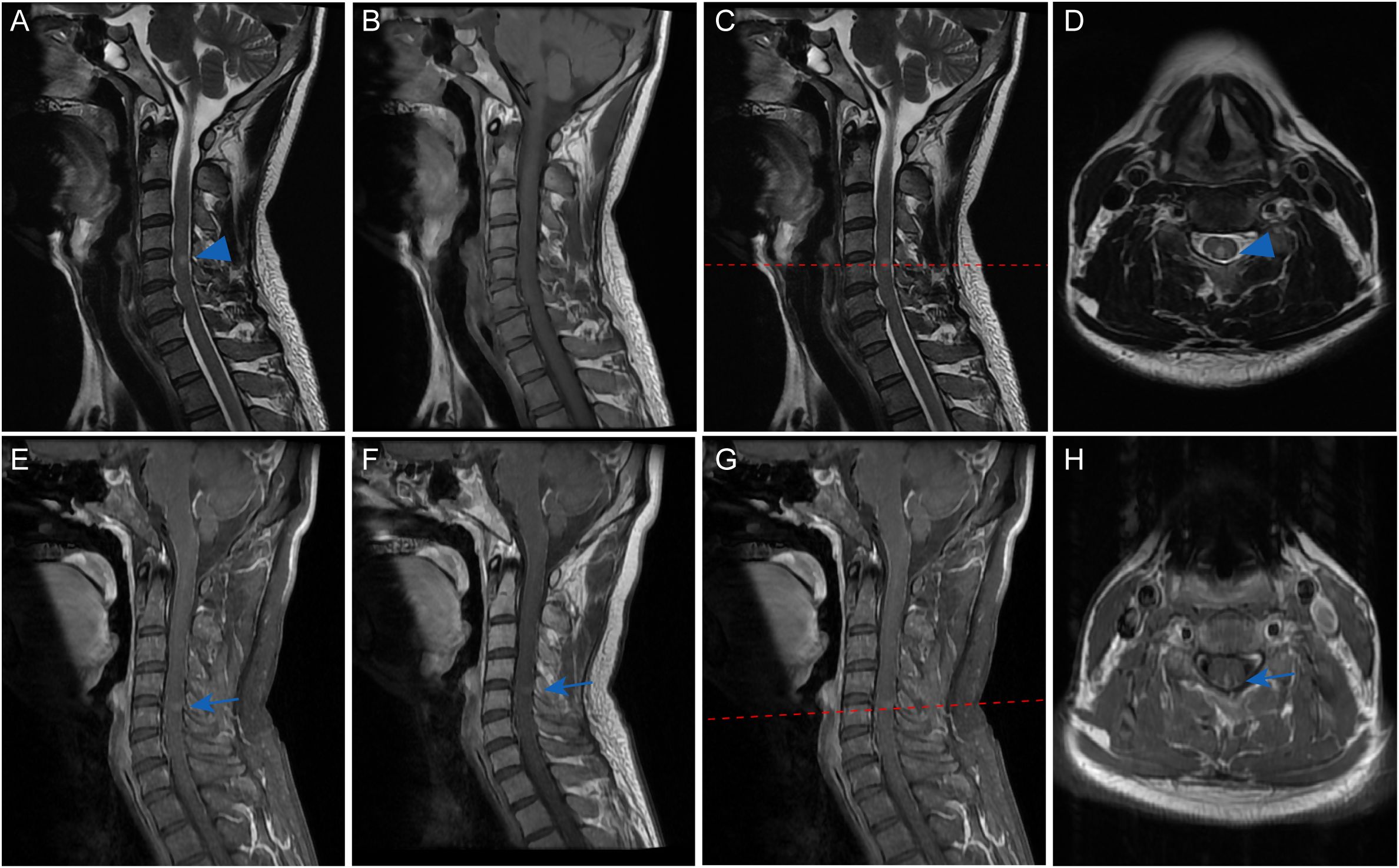 MRI scans of the cervical spine from various angles and orientations. Panels A, B, C, E, F, and G show sagittal views with highlighted areas indicated by arrows. Panels D and H show axial cross-sections with arrows pointing to specific features. Each panel provides a detailed view for clinical evaluation.