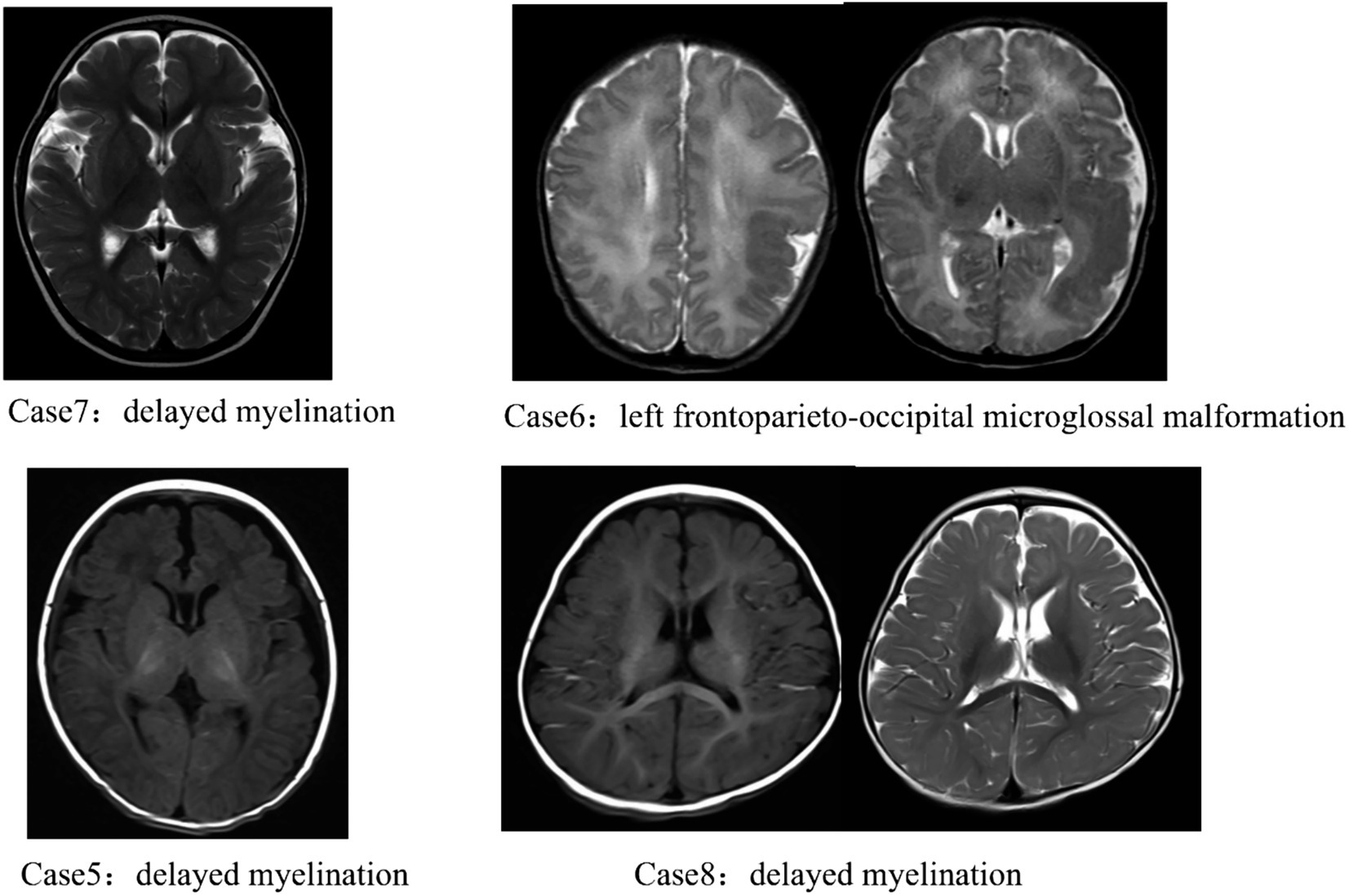 MRI images of four cases. Case 7 and Case 8 show delayed myelination with distinct brain patterns. Case 6 displays left frontoparieto-occipital microglossal malformation with abnormal structural features. Case 5 shows delayed myelination with similar characteristics to Cases 7 and 8.