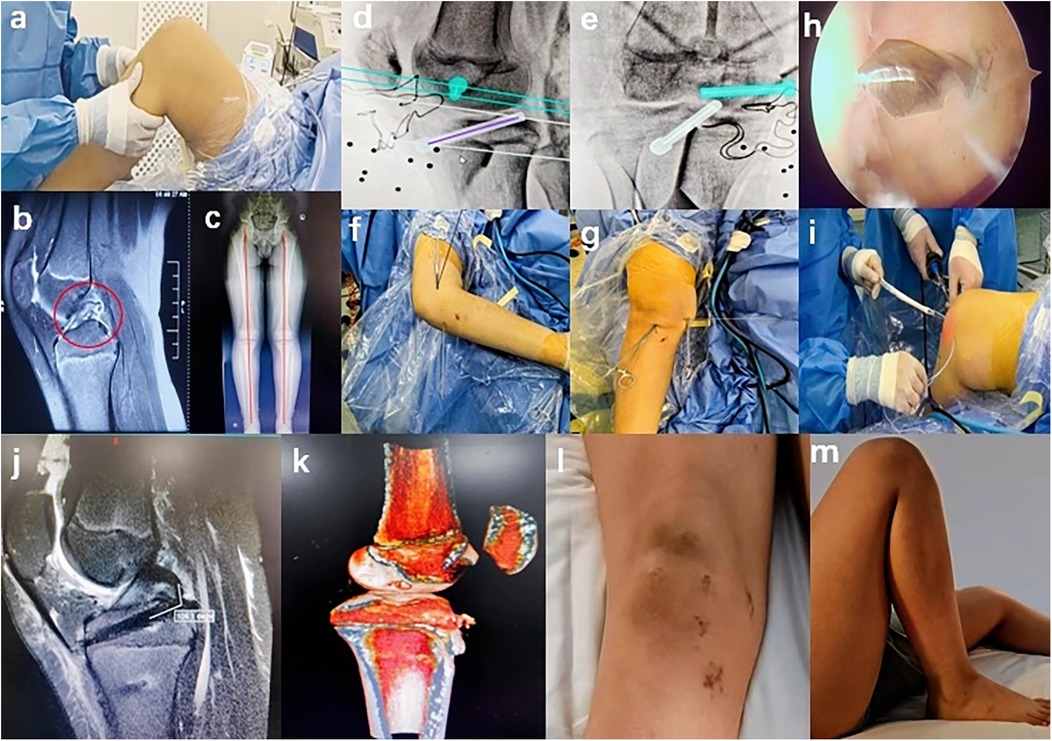 A series of images depicting knee surgery procedures and recovery. Images a, f, g, i show surgical steps with medical personnel and equipment. Images b, c, j, k display X-rays and 3D scans of the knee. Image h is an endoscopic view during surgery. Images l and m show postoperative recovery, with a knee showing healing incision marks.