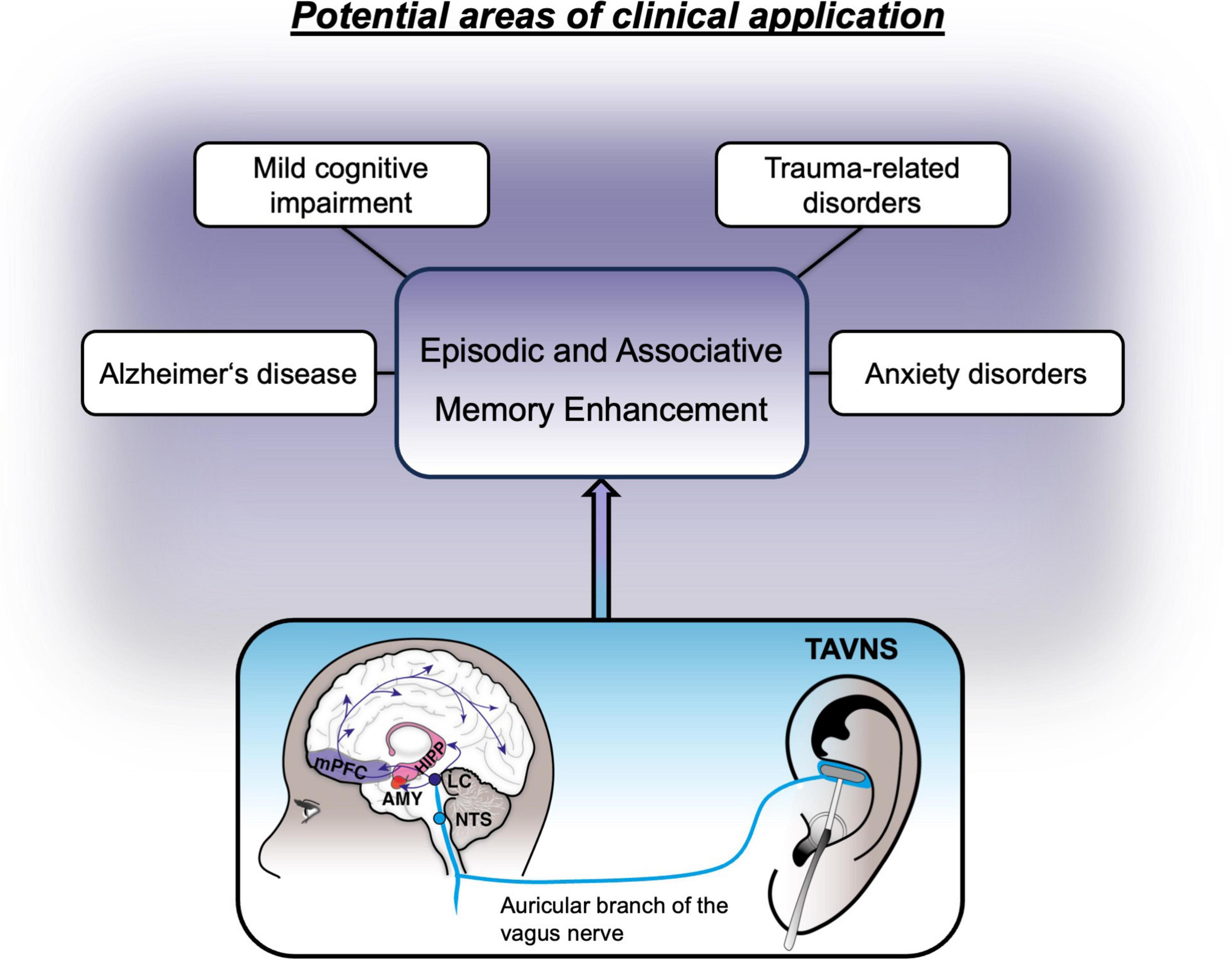 Diagram showing potential clinical applications of episodic and associative memory enhancement using transcutaneous auricular vagus nerve stimulation (TAVNS). Applications include mild cognitive impairment, Alzheimer’s disease, trauma-related disorders, and anxiety disorders. The lower section illustrates the brain's regions impacted by TAVNS, connected by the auricular branch of the vagus nerve to stimulate specific areas.