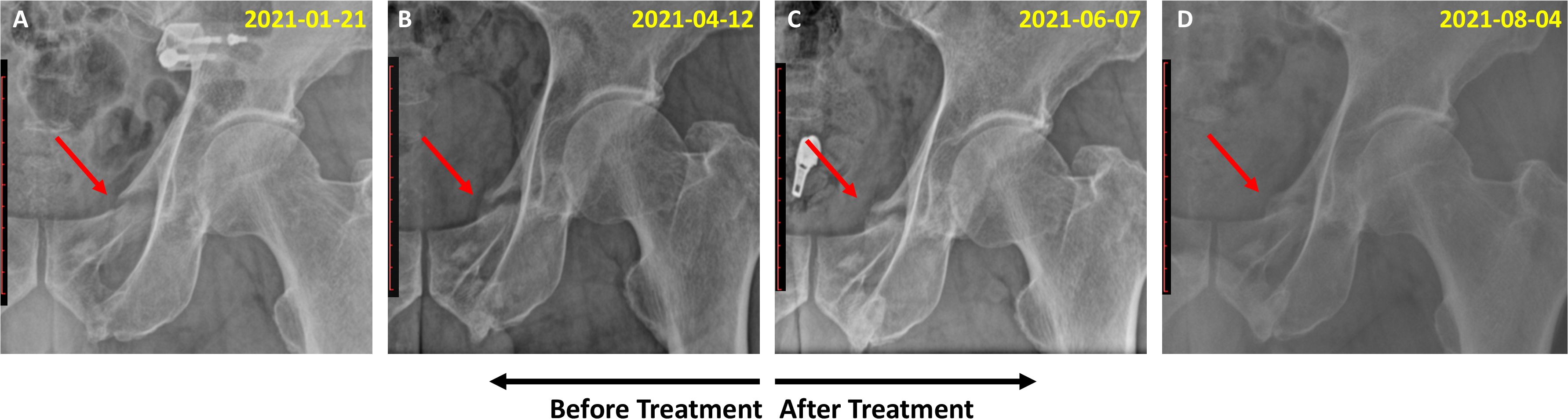 Four hip X-ray images labeled A to D, each with a red arrow indicating a specific area. Dates above each image progress from January 21, 2021, to August 4, 2021, with treatment indicated between images B and C.