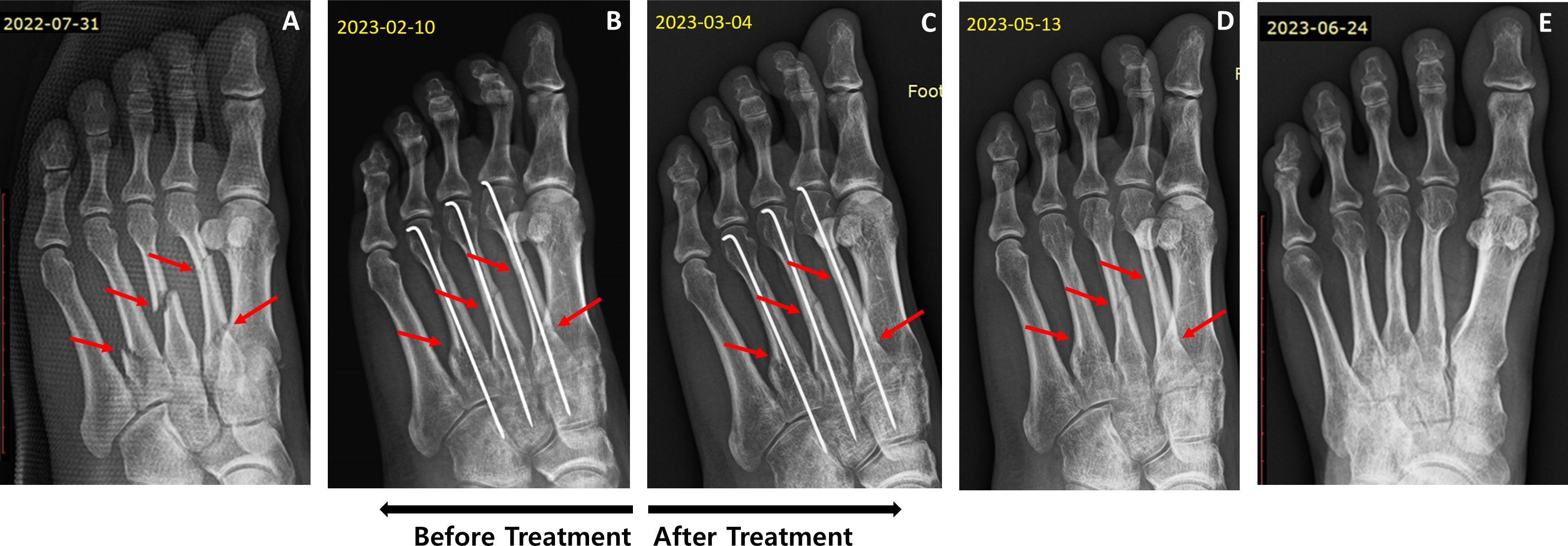 X-ray series showing the progression of a foot fracture treatment over time. Panel A (2022-07-31) shows the initial fracture. Panel B (2023-02-10) and Panel C (2023-03-04) display the insertion of metal rods. Panel D (2023-05-13) and Panel E (2023-06-24) indicate healing progress, with significant bone alignment and healing observed.