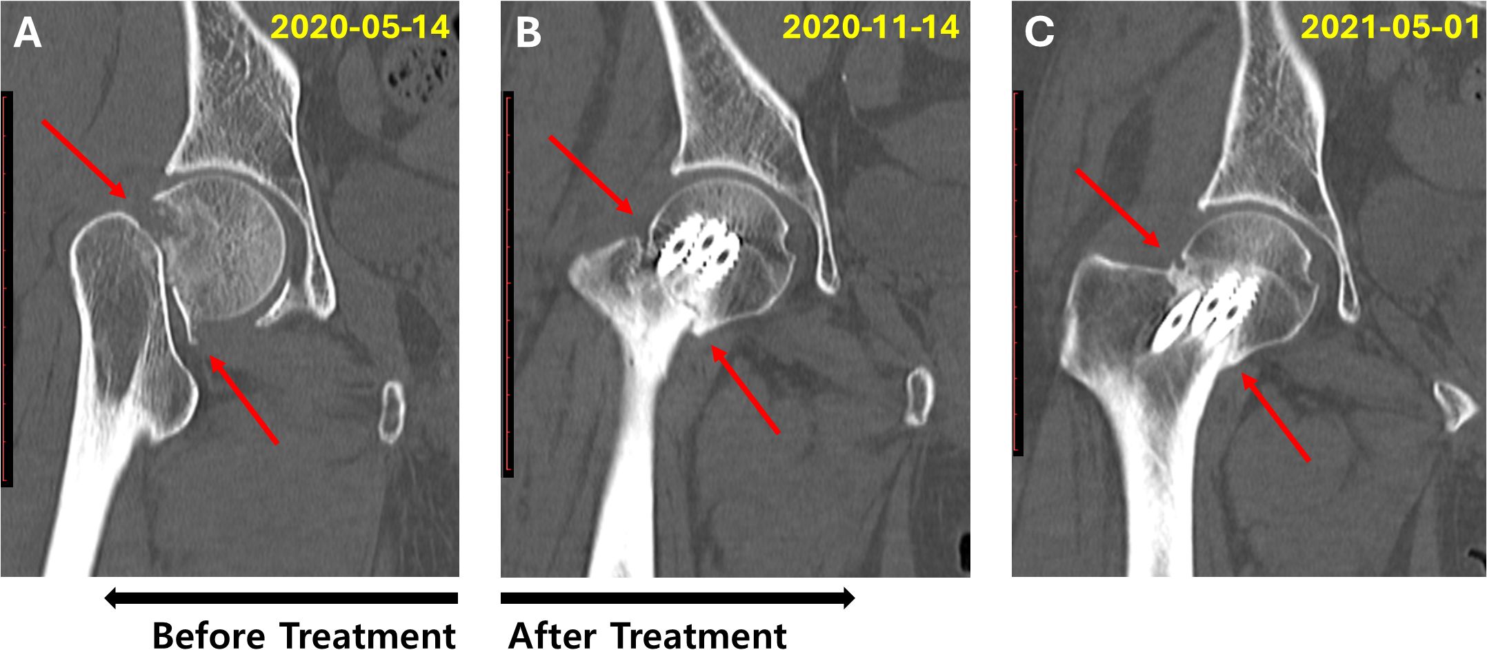 CT scans showing a hip joint in three stages. Image A, dated May 14, 2020, shows the joint before treatment with visible damage. Image B, dated November 14, 2020, shows post-treatment with surgical implants. Image C, dated May 1, 2021, shows the joint healing with implants still present. Red arrows highlight key areas.