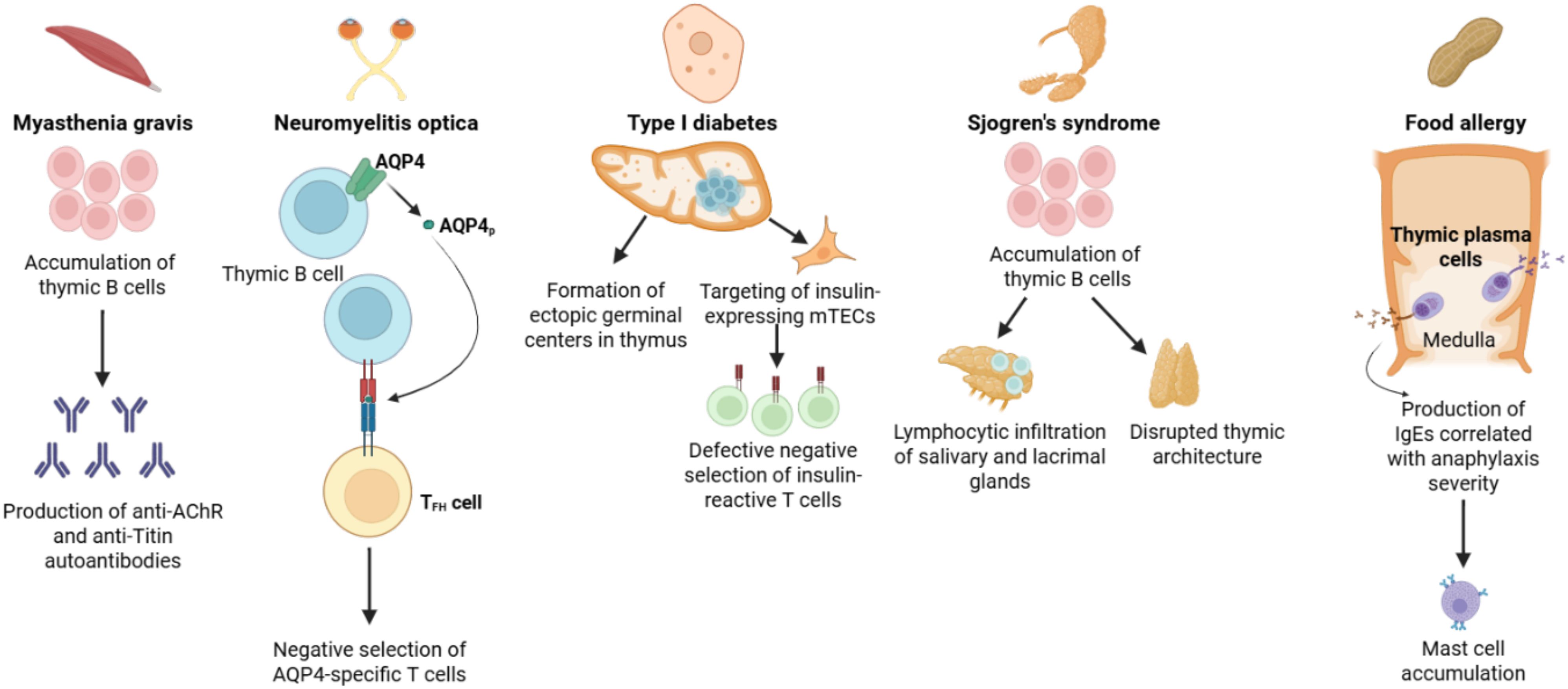 Illustration showing the involvement of the thymus in autoimmune and allergic conditions. For Myasthenia gravis, thymic B cells produce autoantibodies. Neuromyelitis optica involves AQP4-specific T cells. Type I diabetes is related to defective negative selection of T cells. Sjogren's syndrome features lymphocytic infiltration. Food allergies involve IgE production and mast cell accumulation. Each condition shows a biological process and cellular involvement.
