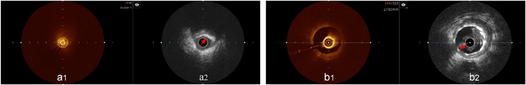 Unclear OCT images (a1, b1) versus corresponding IVUS images showing calcified plaque (a2) and stent visualization (b2). Red arrows highlight plaque/stent features.