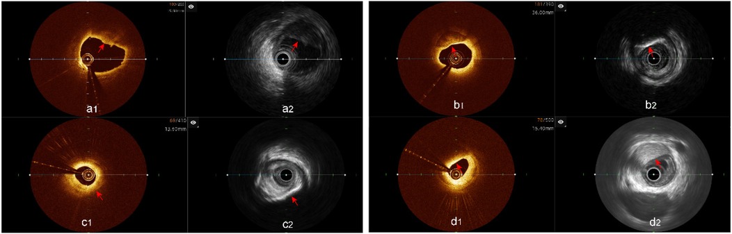 Co-registered IVUS-OCT analysis: Lipid plaques (a1-a2), calcified plaques (b1-b2), discordant cases (c1-c2: OCT lipid vs. IVUS calcification; d1-d2: OCT lipid vs. IVUS fibrous plaque). Red arrows indicate key features.