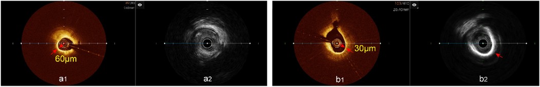Thin-cap fibroatheroma (TCFA) detection: OCT identifies TCFA (a1, b1) while IVUS shows lipid plaque (a2) and calcified plaque (b2). Red arrows highlight TCFA locations.