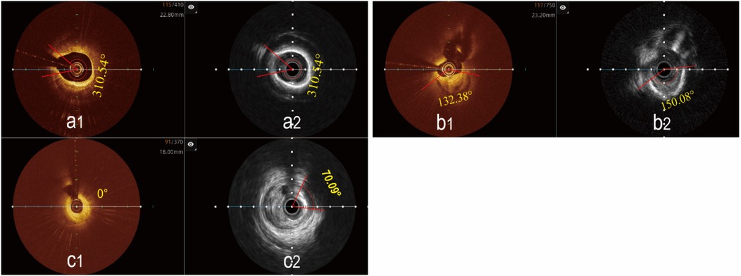 Comparative assessment of maximal calcified plaque arc by IVUS vs. OCT: (a1-a2) Concordant measurement: OCT and IVUS show identical calcification arc (yellow angular markers). (b1-b2) OCT limitation: Superficial calcification arc underestimated by OCT (b1) vs. full-depth IVUS detection (b2). (c1-c2) OCT failure: Deep calcification undetected by OCT (c1) but clearly identified by IVUS (c2; red arrow). Red arrows denote calcification boundaries. Demonstrates IVUS's superior depth penetration for calcified plaque burden quantification.