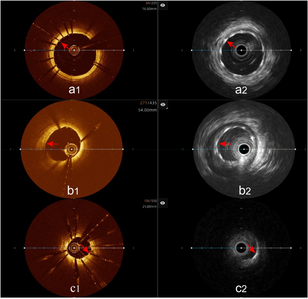 Stent visualization: Clear stent in both modalities (a1-a2), unclear OCT with clear IVUS (b1-b2), clear OCT with unclear IVUS (c1-c2). Red arrows indicate stent struts.