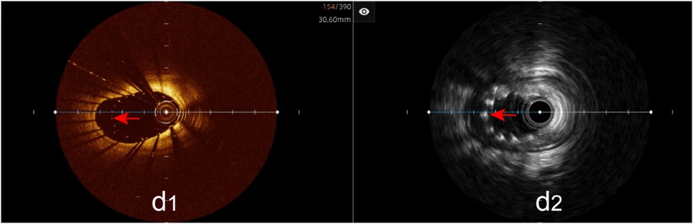 Incomplete stent apposition (≥200 μm gap): Both IVUS (d2) and OCT (d1) show malapposed struts (red arrows).