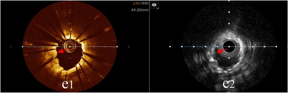 Tissue protrusion: OCT (e1) detects irregular tissue bulging between stent struts (red arrow); IVUS (e2) fails to visualize protrusion.