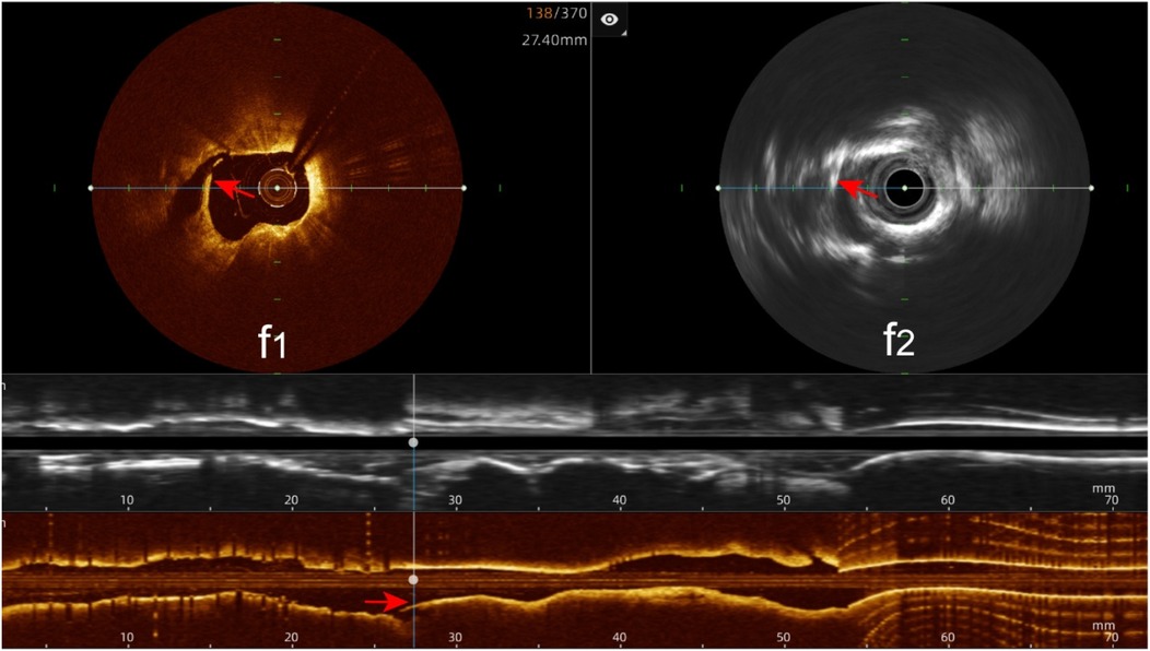 Stent edge dissection. f1, f2: OCT and IVUS clearly show stent edge dissection.