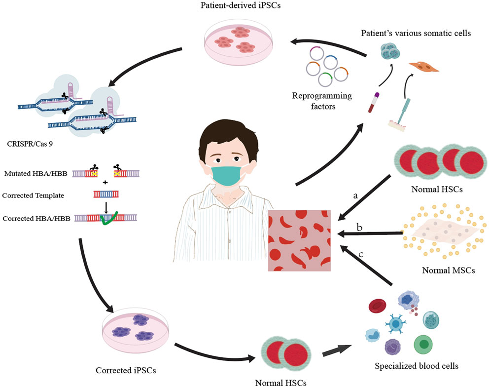 Diagram illustrating a process of gene therapy for a patient. It begins with patient-derived somatic cells, which are reprogrammed into iPSCs (induced pluripotent stem cells) using reprogramming factors. These iPSCs undergo CRISPR/Cas9 editing to correct HBA/HBB mutations. The corrected iPSCs are then differentiated into normal HSCs (hematopoietic stem cells) and MSCs (mesenchymal stem cells). The process aims to yield specialized blood cells for treatment. An illustration of a patient wearing a mask is central, surrounded by arrows indicating the flow of steps.