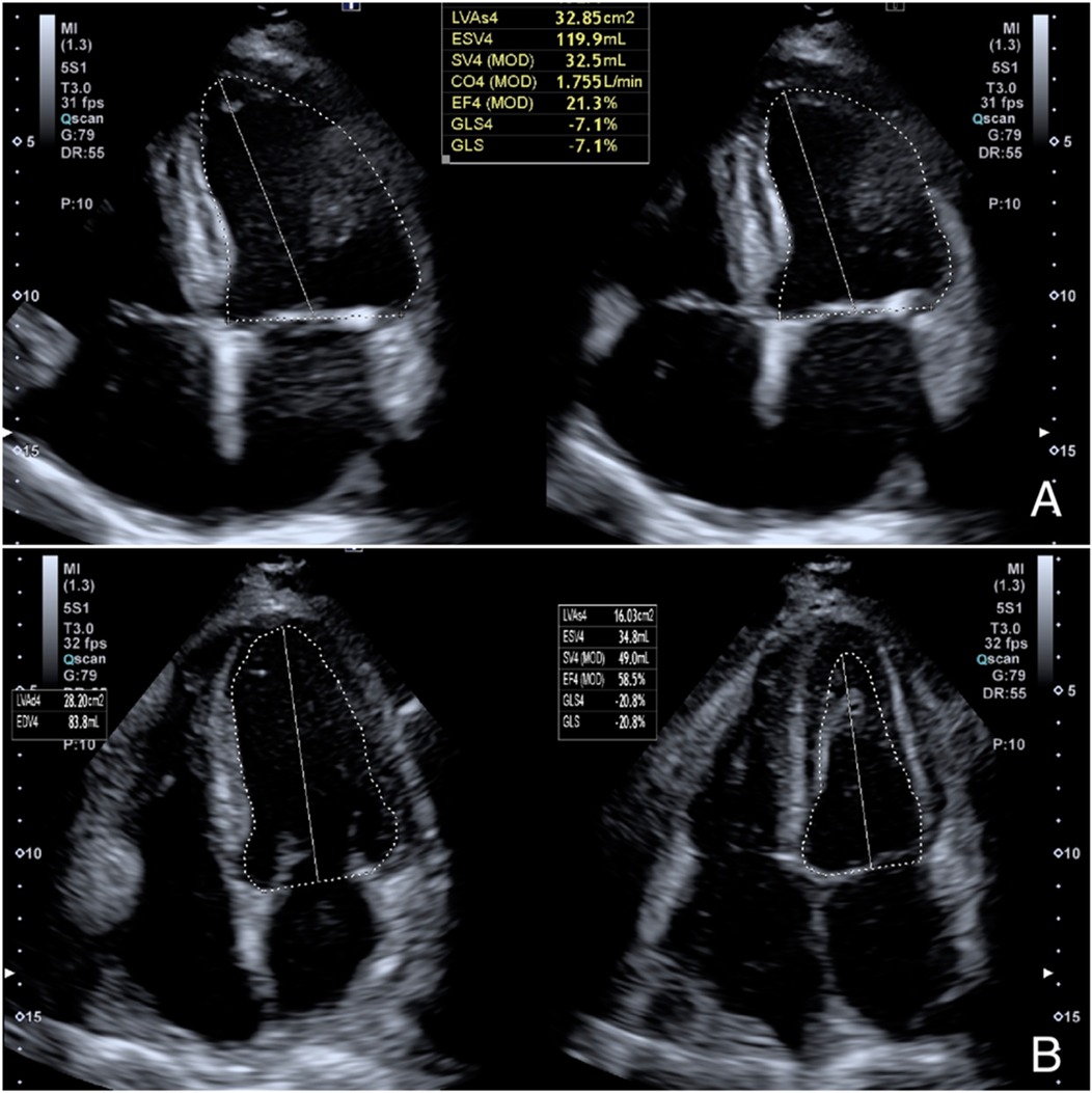 Four echocardiogram images display different heart views labeled A and B. Measurements and values, such as LVA, ESV, SV, CO, EF, and GLS, are shown alongside each image. Dashed lines outline parts of the heart, with numeric data indicating heart function metrics such as size and volume.