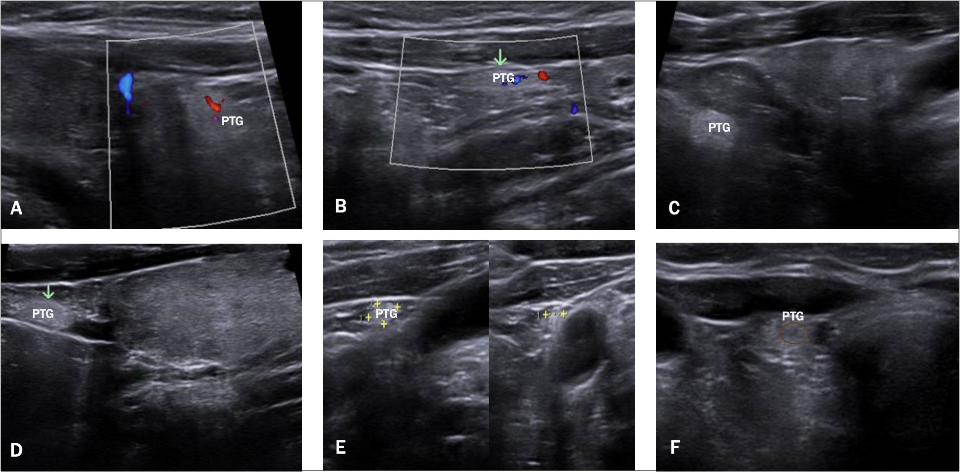 Ultrasound images labeled A to F display the parathyroid gland (PTG) in varying views. Color Doppler is seen in A and B, highlighting blood flow with red and blue signals. The PTG is marked clearly in each image. Each panel provides a distinct perspective of the gland’s appearance and location.