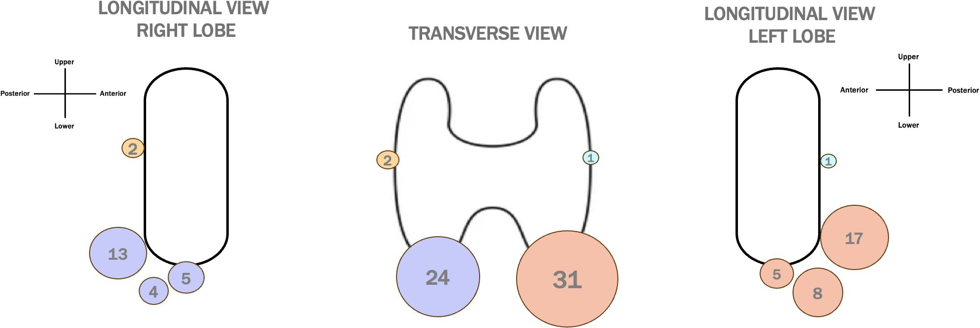 Three schematic diagrams show views of a thyroid gland. The first is a longitudinal view of the right lobe, highlighting areas labeled 2, 13, 4, and 5. The second is a transverse view with labels 2, 1, 24, and 31. The third is a longitudinal view of the left lobe, showing labels 1, 17, 5, and 8. Each label is in a circle of varying color and size. Orientation markers indicate upper, lower, anterior, and posterior directions.