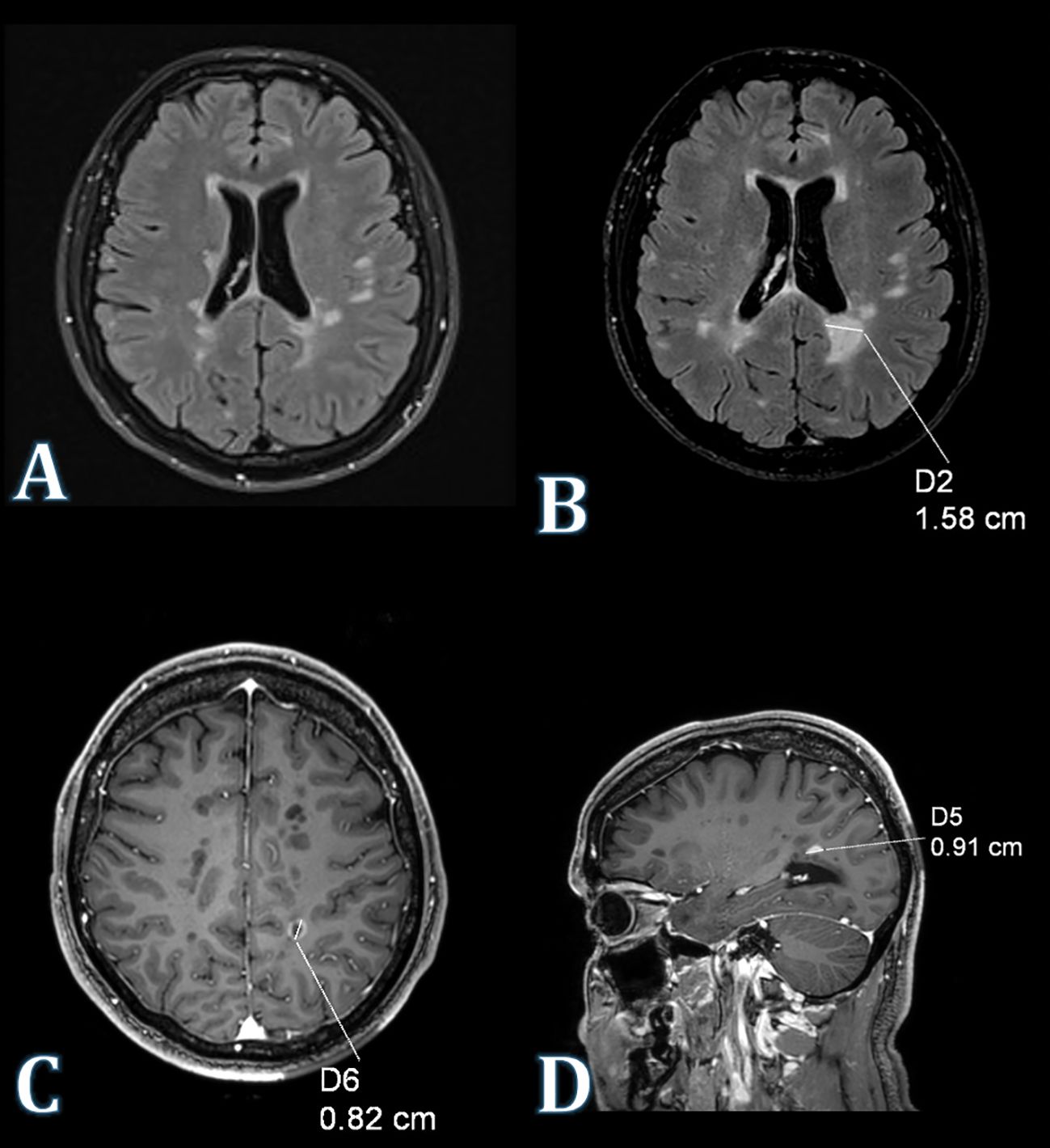 Four MRI brain scans labeled A to D. Image A shows a transverse section without annotations. Image B, another transverse section, highlights a lesion labeled D2 measuring one point five eight centimeters. Image C displays a transverse view with a lesion labeled D6 measuring zero point eight two centimeters. Image D shows a sagittal view with a lesion labeled D5 measuring zero point nine one centimeters.