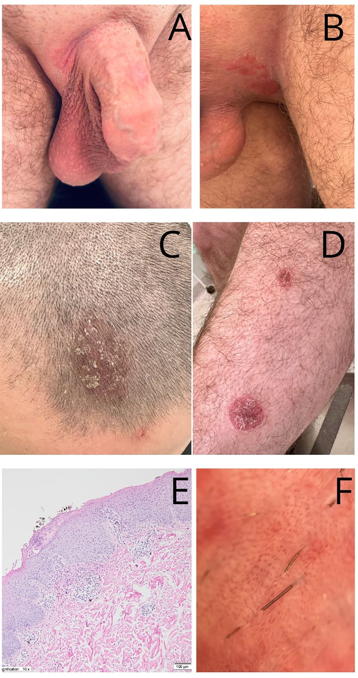 A series of clinical images labeled A to F. A and B show genital areas with red patches. C displays a scalp with patchy hair loss and scaly skin. D depicts a leg with circular red lesions. E is a microscopic view of tissue, showing layers of skin. F focuses on red, irritated skin with visible hair follicles.