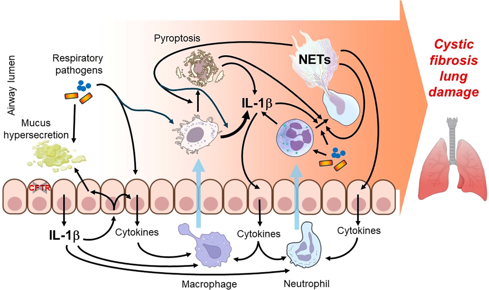 Illustration depicting the pathophysiology of cystic fibrosis lung damage. Respiratory pathogens cause mucus hypersecretion and enter airway cells, where CFTR is also indicated. This triggers cytokine release, pyroptosis, and formation of NETs (neutrophil extracellular traps). IL-1β is involved in inflammatory pathways, leading to lung damage. Macrophages and neutrophils play roles in the process. An arrow points to a depiction of inflamed lungs labeled “Cystic fibrosis lung damage.