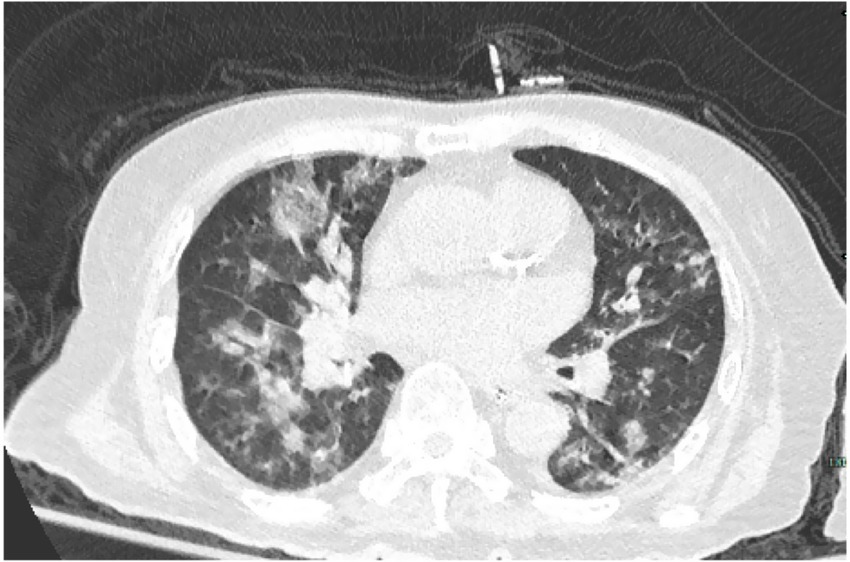 CT scan of a thorax showing axial view of the lungs. Several areas of high-density opacities are visible, suggesting possible abnormalities. The heart and surrounding structures are centrally located.