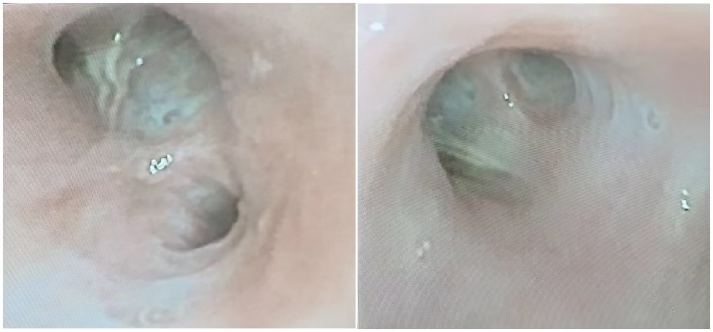 Two medical endoscopic images side by side showing close-up views of the intestines. Both images feature pale, fleshy interior walls with visible indentations and a smooth surface texture. Small white spots are present on each side.