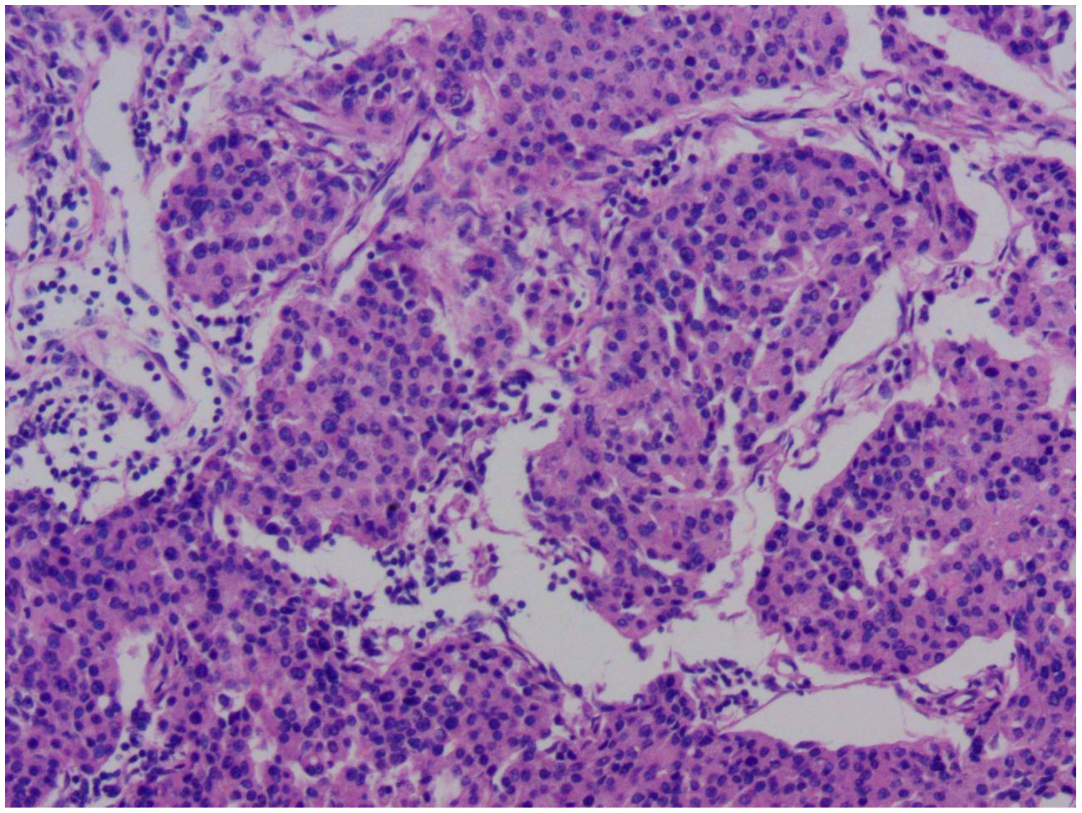 Microscopic image of lung tissue showcasing small cell clusters with densely packed, dark-stained nuclei interspersed within a light pink matrix, typical of a histological examination.