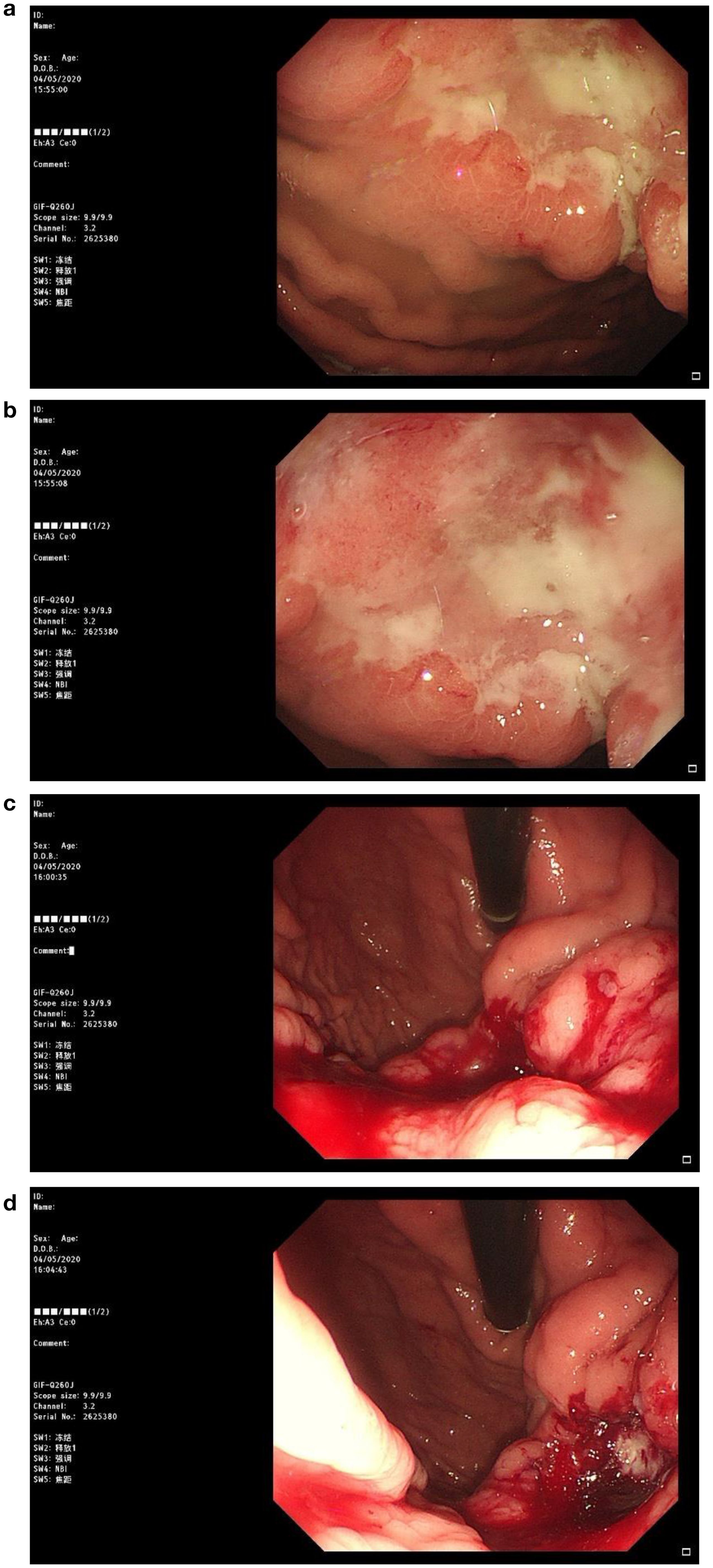 Endoscopic images showing gastric mucosa. Image a and b display inflamed areas with a white exudate suggestive of necrotic tissue. Image c and d show the same regions post-treatment with visible reductions in inflammation and exudate, with some areas of fresh blood.