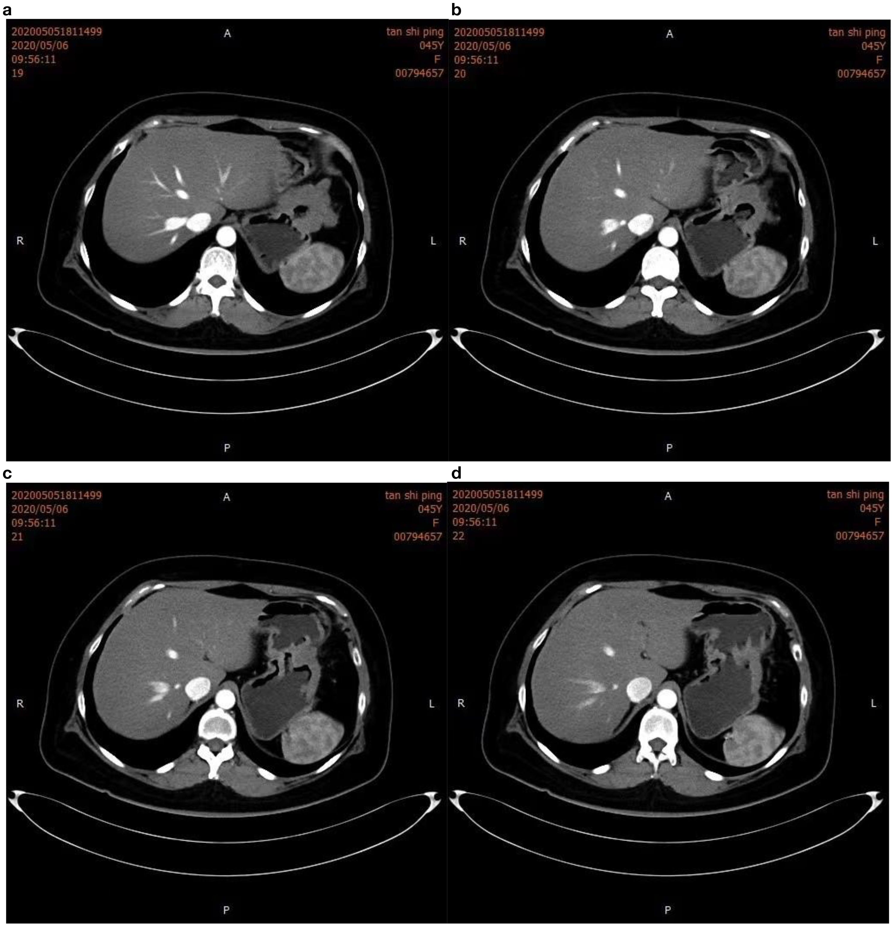 Four CT scan images labeled a, b, c, and d, display axial sections of an abdominal region. Each image shows varying densities and structures of internal organs, likely focusing on different stages or angles for diagnostic purposes.