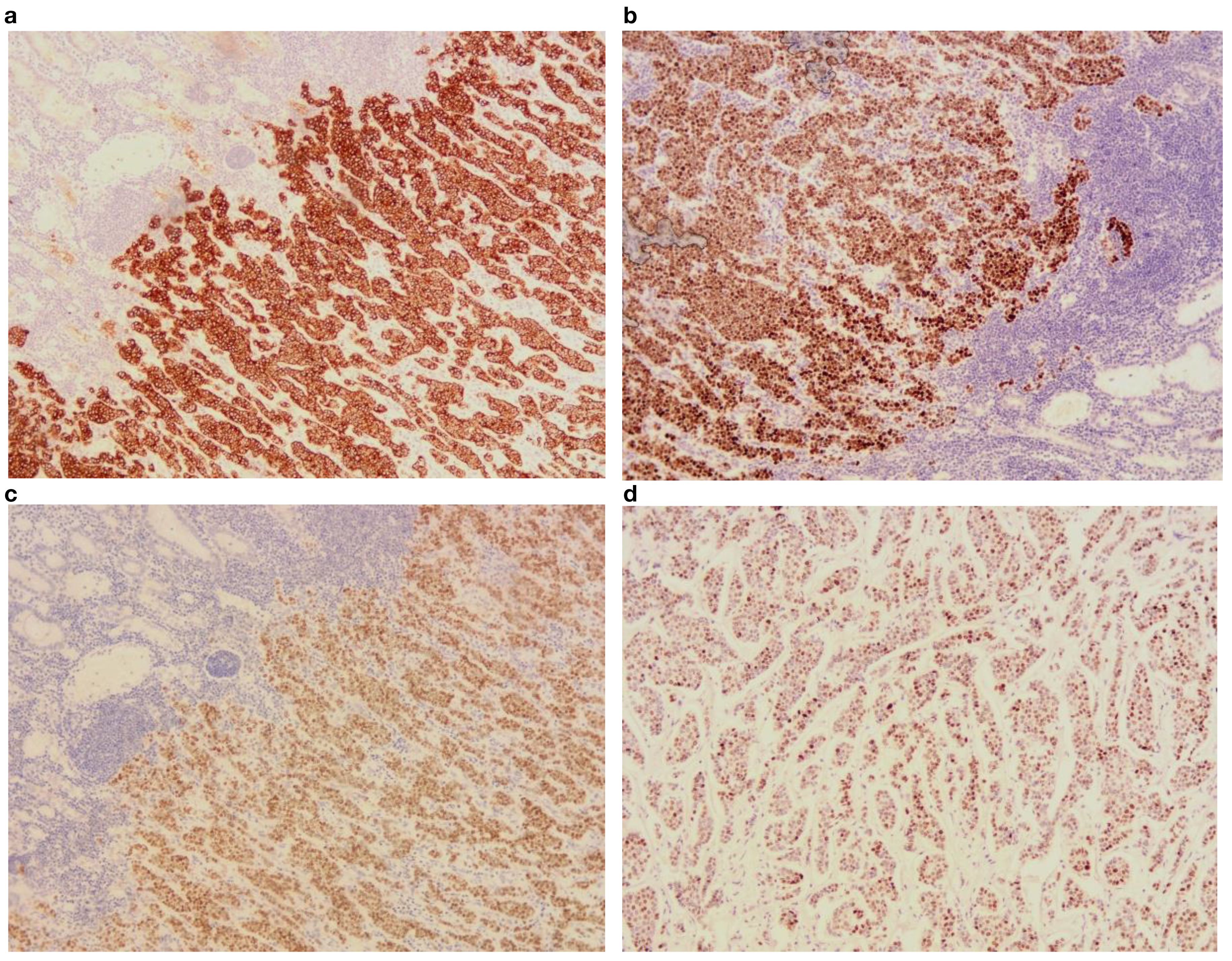 Histology slide showing four panels of immunohistochemistry staining: Panel a. CK(+) with dense brown staining, Panel b. ER(+) with clustered brown staining, Panel c. GATA(+) with moderate brown staining, Panel d. PR(+) with diffuse brown staining. Each panel shows varying staining intensity and distribution.