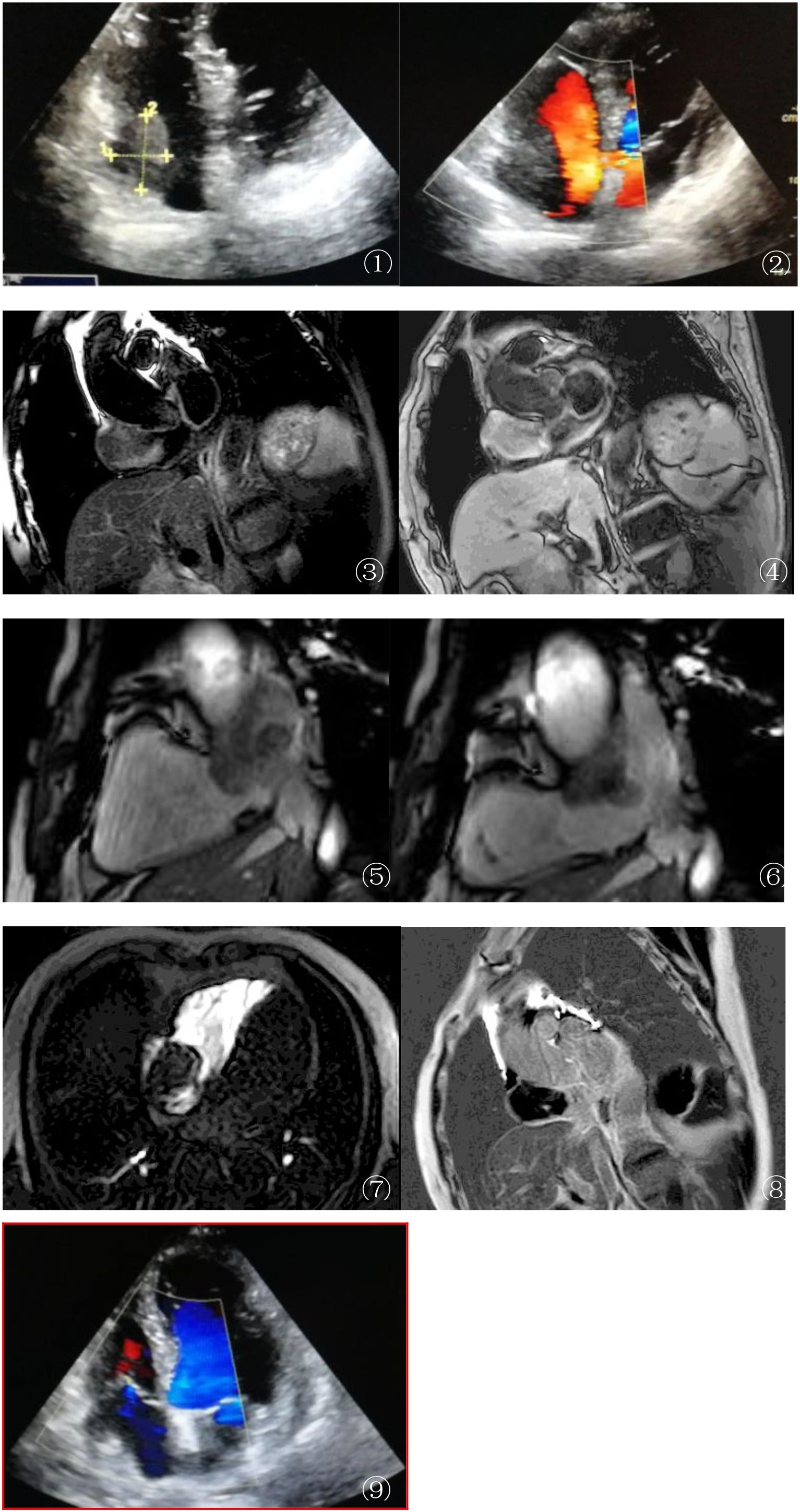 A series of medical imaging scans depicting organs and blood flow patterns. Images 1 and 2 show ultrasound scans with measurements and blood flow in color. Images 3 to 8 display various MRI scans, likely of the heart and surrounding structures, in different orientations and cross-sections. Image 9, highlighted with a red border, shows another ultrasound scan with color Doppler imaging, indicating blood flow direction and velocity.