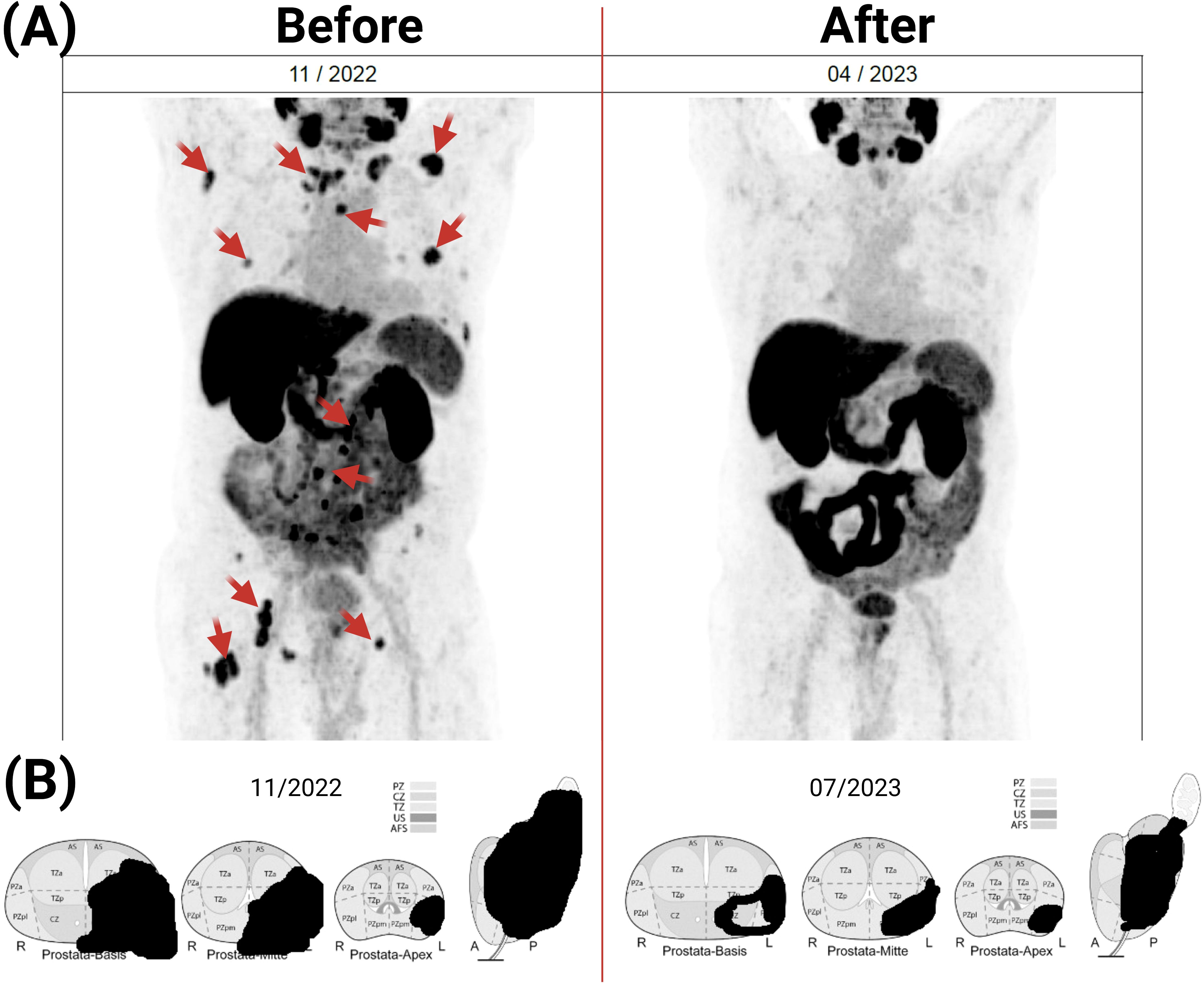 (A) Two PET scans compare before and after treatment results. The “Before” scan from November 2022 shows multiple highlighted areas with red arrows indicating activity. The “After” scan from April 2023 shows reduced activity. (B) Charts compare prostate sections from November 2022 and July 2023, showing changes in activity levels across sections labeled PZ, CZ, TZ, US, AFS.