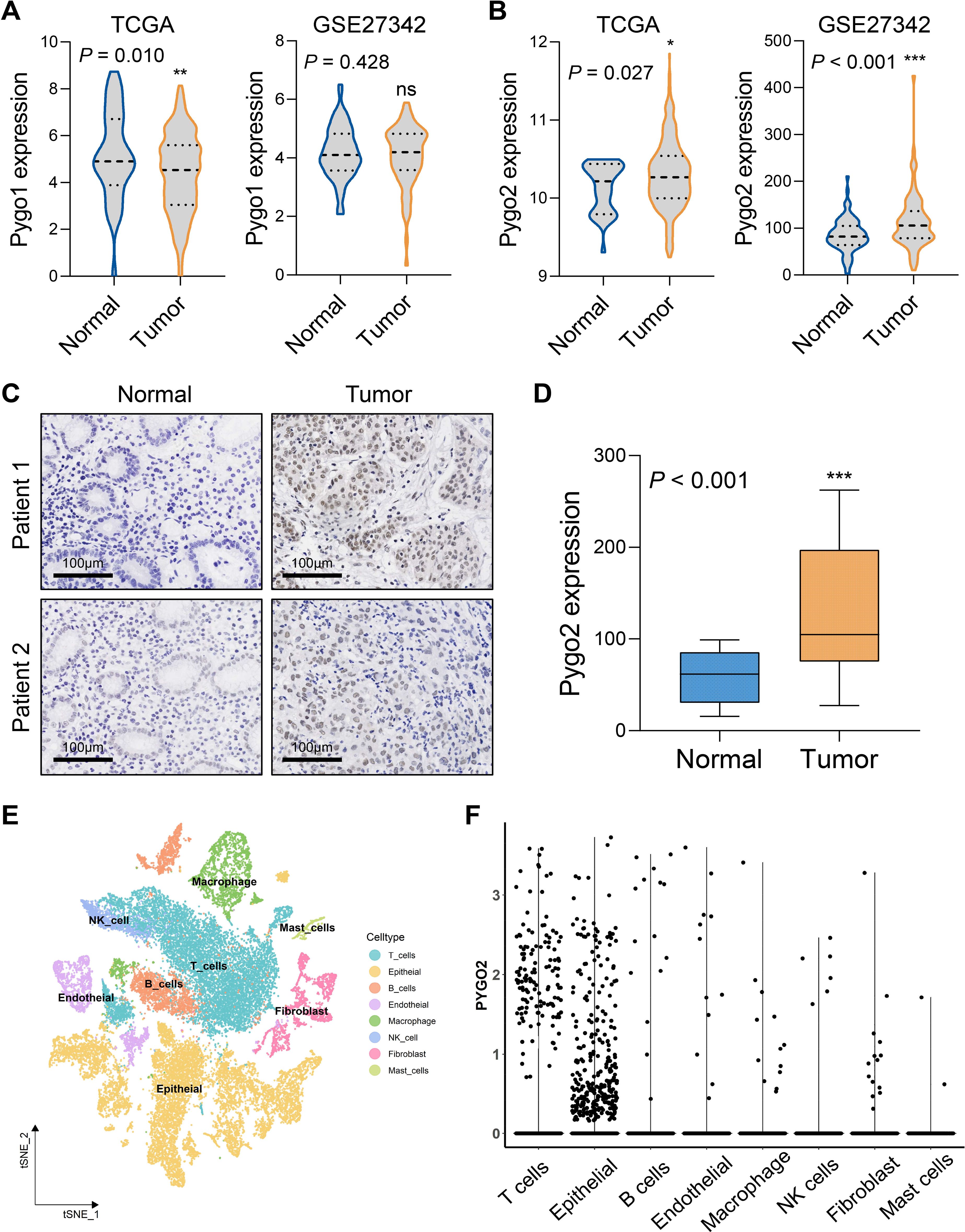 Violin plots (A and B) compare the expression of Pygo1 and Pygo2 in normal versus tumor samples from TCGA and GSE27342 datasets, indicating significant differences. Panel C shows immunohistochemistry images for Pygo2 in normal and tumor tissues from two patients. Panel D is a box plot displaying Pygo2 expression levels, showing higher expression in tumor tissue. Panel E is a t-SNE plot displaying the distribution of cell types, labeled with colors. Panel F is a dot plot showing Pygo2 expression across various cell types, including T cells and epithelial cells.