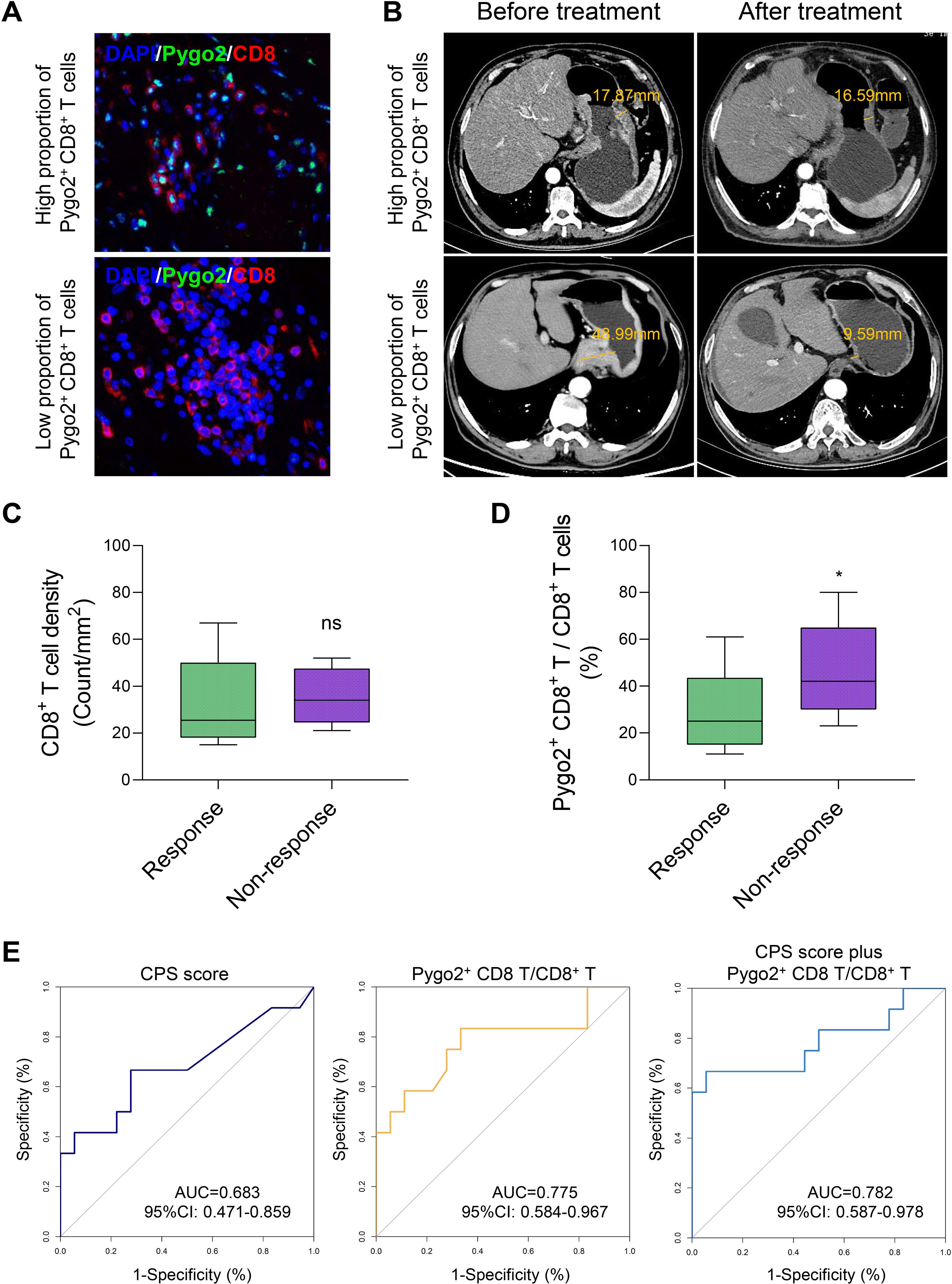Panel A shows fluorescent staining of Pygo2 and CD8 T cells with high and low proportions. Panel B displays CT scans before and after treatment, showing tumor size changes (17.47 mm to 16.59 mm vs. 29.99 mm to 9.59 mm). Panel C contains a box plot comparing CD8 T cell density between responders and non-responders, marked as not significant. Panel D shows a box plot with higher Pygo2+ CD8 T cell percentages in responders. Panel E presents ROC curves comparing CPS score, Pygo2+ CD8 T/CD8+ T ratio, and combined metrics, with specific AUC values for each.