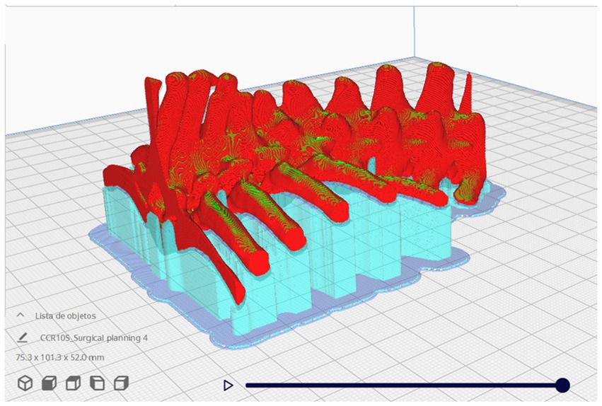 3D rendering of a surgical model featuring complex, interwoven red and green structures atop a blue base on a grid platform. Interface elements and dimensions are visible on the side.