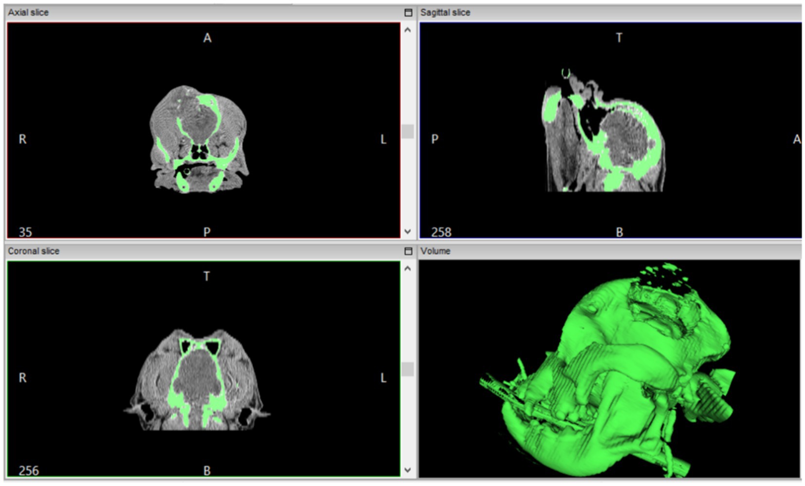CT scan images showing axial, sagittal, and coronal slices, alongside a 3D volume rendering. The scans highlight anatomical structures in green against a black background, with labeled directions such as anterior, posterior, right, left, top, and bottom.